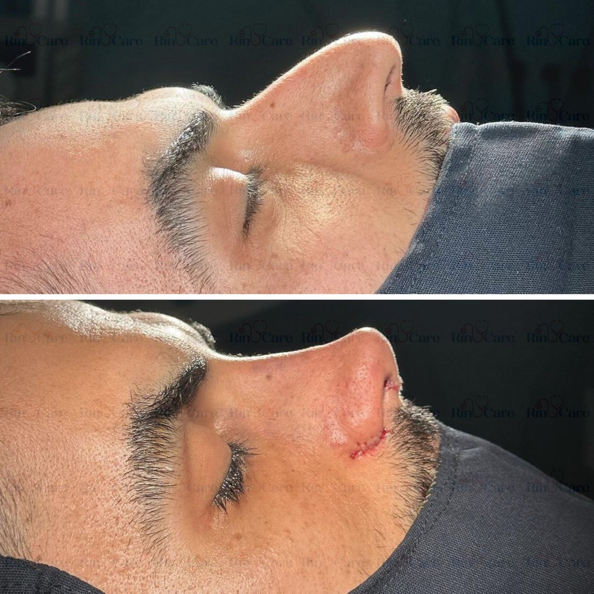 rinucare's tweet photo. #Rhinoplasty #NoseJob #RhinoplastyJourney #RhinoplastyBeforeAndAfter #RhinoplastyRecovery #RhinoplastyResults #RhinoplastySurgery #RhinoplastySpecialist #RevisionRhinoplasty #NoseSurgery #Septorhinoplasty #ClosedRhinoplasty #OpenRhinoplasty #EthnicRhinoplasty https://t.co/tMh2V71V71