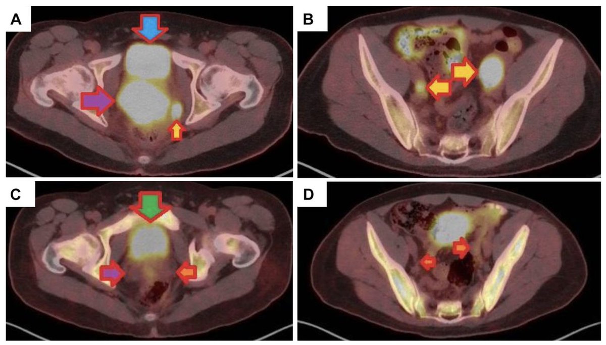 Weill Cornell Medicine Pathology (@wcmcpathology) on Twitter photo New research by <a href="/WCMCPathology/">Weill Cornell Medicine Pathology</a> and <a href="/WCMEnglanderIPM/">WCM Englander Institute for Precision Medicine</a> in <a href="/IIAR_Journals/">International Institute of Anticancer Research</a>, "Unusual Presentation of Advanced #UrothelialCancer in a Young Patient," highlights the complexity of treatment and importance of #precisionmedicine and innovative treatment options.
ar.iiarjournals.org/content/45/2/6… New research by <a href="/WCMCPathology/">Weill Cornell Medicine Pathology</a> and <a href="/WCMEnglanderIPM/">WCM Englander Institute for Precision Medicine</a> in <a href="/IIAR_Journals/">International Institute of Anticancer Research</a>, "Unusual Presentation of Advanced #UrothelialCancer in a Young Patient," highlights the complexity of treatment and importance of #precisionmedicine and innovative treatment options.
ar.iiarjournals.org/content/45/2/6…