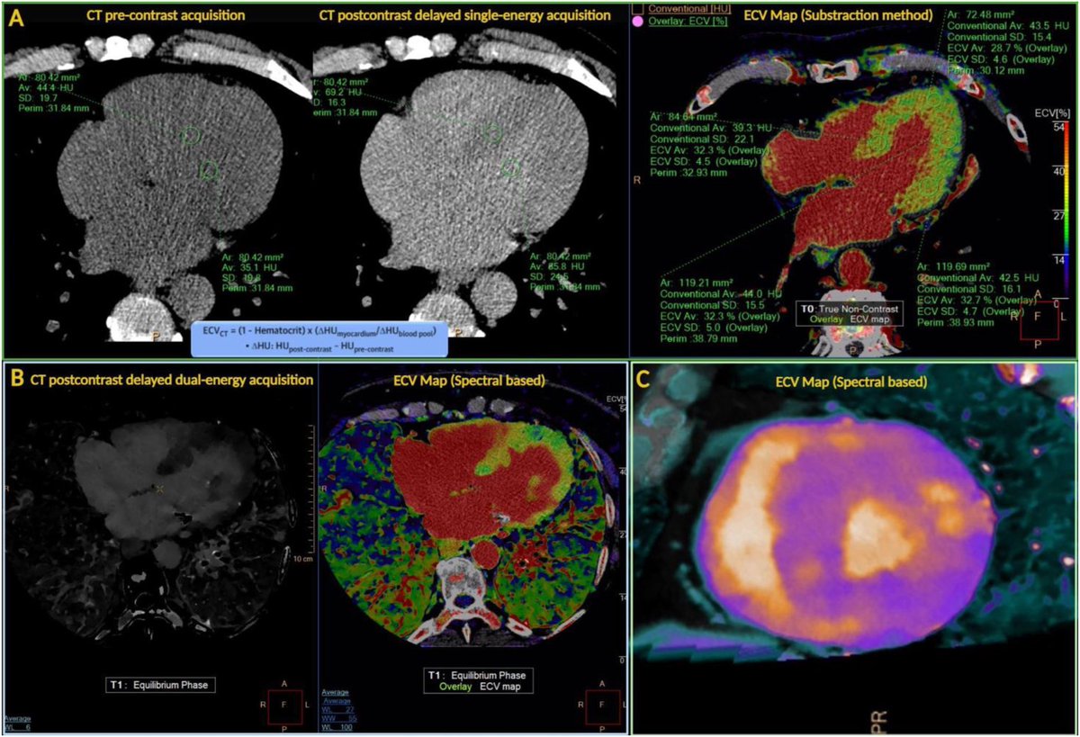 Leandro Slipczuk (@cardiomdphd) on Twitter photo Novel CT-derived markers for enhanced long-term risk stratification in the planning of TAVR for aortic stenosis <a href="/journalCCT/">Journal of Cardiovascular CT</a>
<a href="/danilorenzatti/">Daniel Lorenzatti, MD.</a> <a href="/analyzeF/">Annalisa Filtz</a> <a href="/JolienGeers/">Jolien Geers</a> <a href="/KajetanGrodecki/">Kajetan Grodecki</a> <a href="/vitajaspan/">Vita Jaspan</a> <a href="/RonBlankstein/">Ron Blankstein</a> <a href="/ThomasTreibel/">Thomas Treibel</a> <a href="/JoaoLCavalcante/">João Cavalcante</a> <a href="/lesleejshaw/">Leslee Shaw</a> <a href="/Piotr_JSlomka/">Piotr Slomka PhD</a> <a href="/damini_dey/">Damini Dey</a> Novel CT-derived markers for enhanced long-term risk stratification in the planning of TAVR for aortic stenosis <a href="/journalCCT/">Journal of Cardiovascular CT</a>
<a href="/danilorenzatti/">Daniel Lorenzatti, MD.</a> <a href="/analyzeF/">Annalisa Filtz</a> <a href="/JolienGeers/">Jolien Geers</a> <a href="/KajetanGrodecki/">Kajetan Grodecki</a> <a href="/vitajaspan/">Vita Jaspan</a> <a href="/RonBlankstein/">Ron Blankstein</a> <a href="/ThomasTreibel/">Thomas Treibel</a> <a href="/JoaoLCavalcante/">João Cavalcante</a> <a href="/lesleejshaw/">Leslee Shaw</a> <a href="/Piotr_JSlomka/">Piotr Slomka PhD</a> <a href="/damini_dey/">Damini Dey</a>