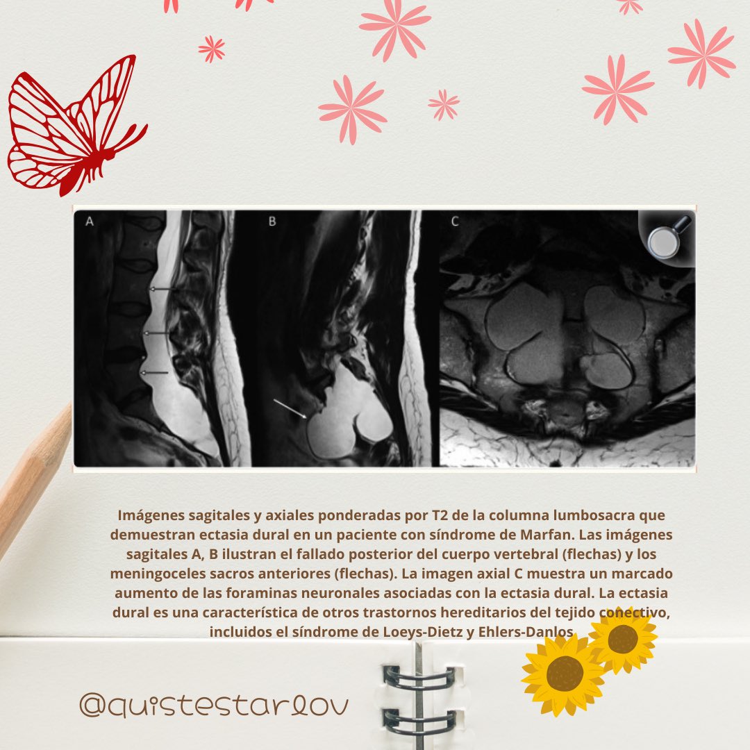Ciencia e #investigación por #FebreroRaro 

Los #QuistesTarlov están infradiagnosticados, pero hay que aprender a cribar y comprender la alteración de tejido conectivo y la sinergia con patologías como <a href="/SIMA_Asociacion/">SIMA Asociación</a> <a href="/ANSEDH/">ANSEDH • Ehlers-Danlos e Hiperlaxitud España</a> <a href="/afosfolipido/">SAF España</a> …

pmc.ncbi.nlm.nih.gov/articles/PMC10…