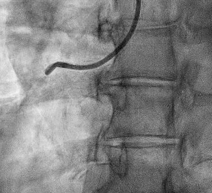 agtruesdell's tweet photo. 1/2 #CTO skills for non-CTO PCI. Inferior STEMI. Ongoing VF Arrest. Guide and Wire dissection during CPR and wiring: proven by #ImageAlways IVUS 👁️. No more injections… https://t.co/YyHyLOMOIB