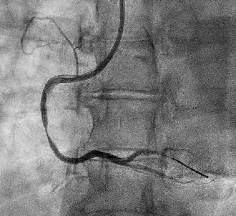 agtruesdell's tweet photo. 1/2 #CTO skills for non-CTO PCI. Inferior STEMI. Ongoing VF Arrest. Guide and Wire dissection during CPR and wiring: proven by #ImageAlways IVUS 👁️. No more injections… https://t.co/YyHyLOMOIB