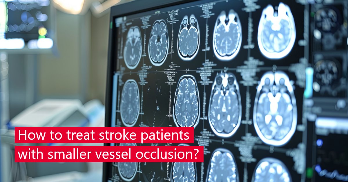 Faculty of Medicine, University of Bern (@medfacultyunibe) on Twitter photo New study on #stroke therapy found that catheter-based therapy provides no added benefit over standard medication therapy for patients with medium-sized or smaller vessel occlusions.đnejm.org/doi/full/10.10⊠đCongrats to <a href="/FishingNeurons/">Urs Martin Fischer</a> of <a href="/unibern/">UniversitĂ€t Bern</a> & <a href="/inselgruppe/">Insel Gruppe</a> and colleagues! New study on #stroke therapy found that catheter-based therapy provides no added benefit over standard medication therapy for patients with medium-sized or smaller vessel occlusions.đnejm.org/doi/full/10.10⊠đCongrats to <a href="/FishingNeurons/">Urs Martin Fischer</a> of <a href="/unibern/">UniversitĂ€t Bern</a> & <a href="/inselgruppe/">Insel Gruppe</a> and colleagues!