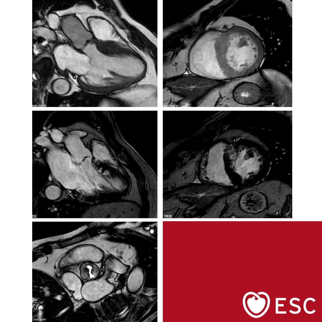 escardio's tweet photo. #ImageOfTheWeek by Andrea Provera, Ginevra Annoni and Edoardo Conte from IRCCS Galeazzi Sant'Ambrogio in Milan, Italy.
What is the imaging finding for this 57-year-old male with increased interventricular septal thickness? https://t.co/3E9wi2JUp1
#cardioed #ESCYoung https://t.co/HyRXUormG2