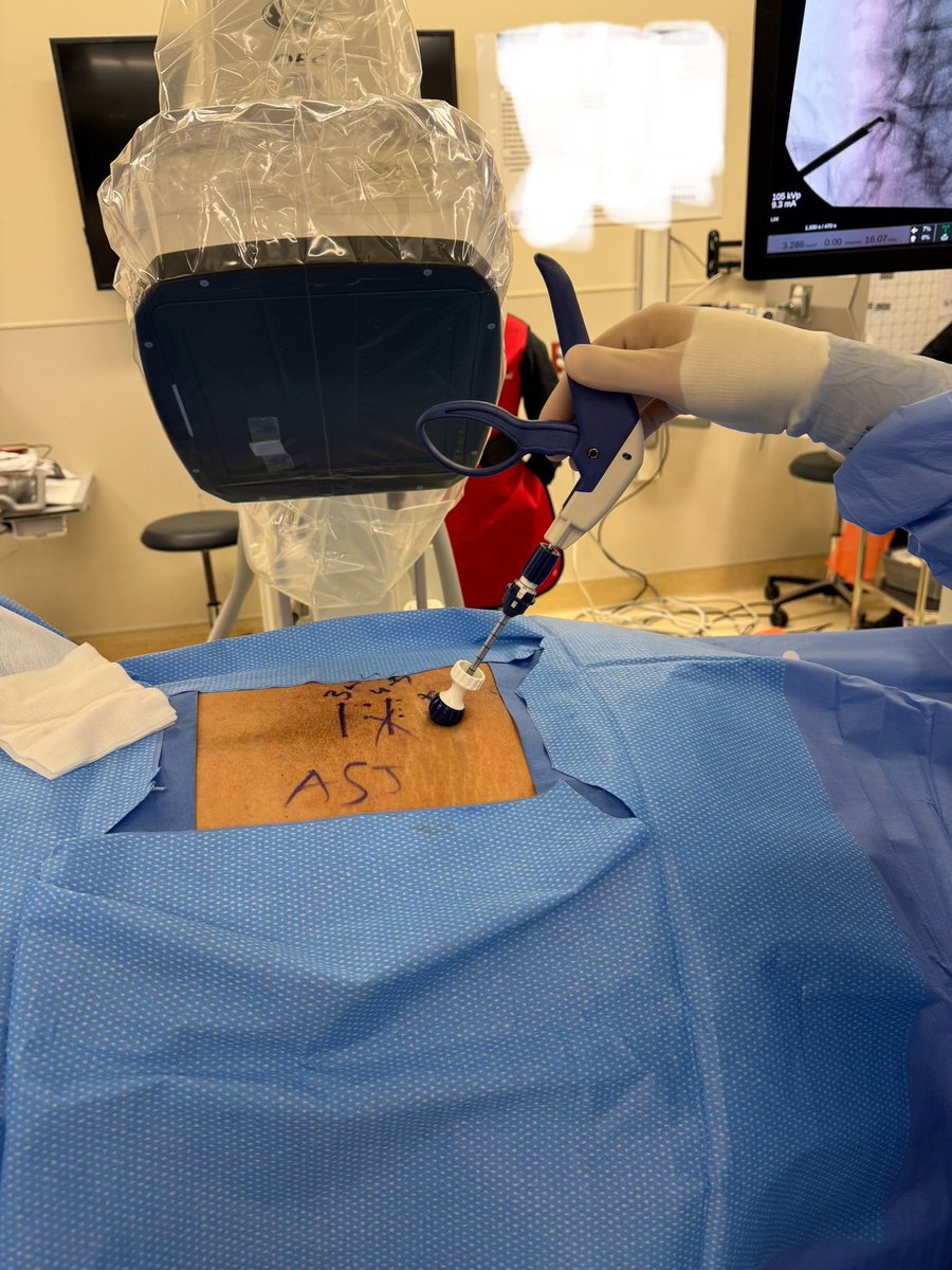 asterkawi's tweet photo. Today, I had the opportunity to use the new kit of #MILD (minimal invasive lumbar decompression) from #Vertos #Strykler. Definitely an excellent treatment for well-selected patients. https://t.co/gRtu9bl3ZZ