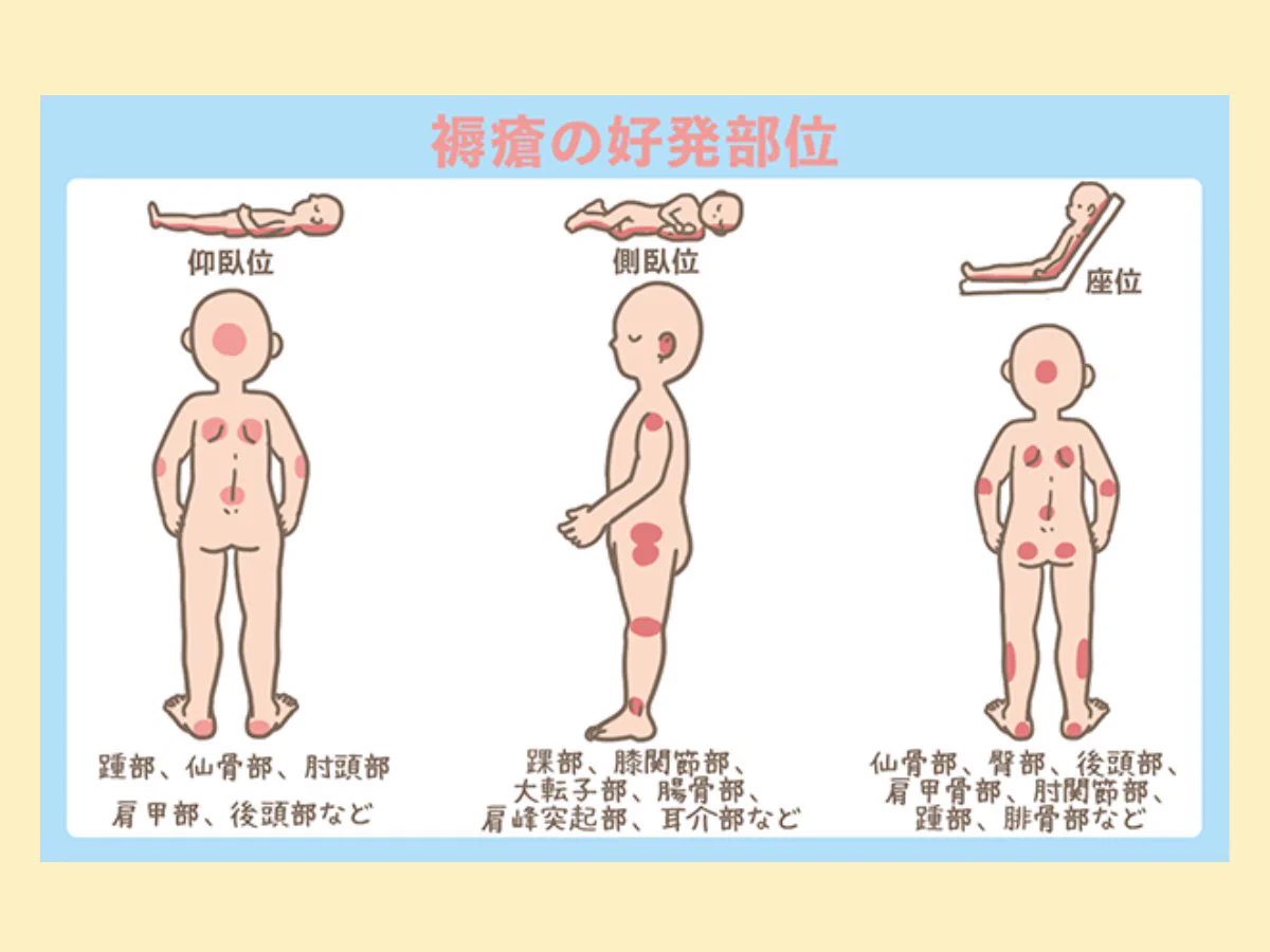 褥瘡 好 発 部位 仰臥 位