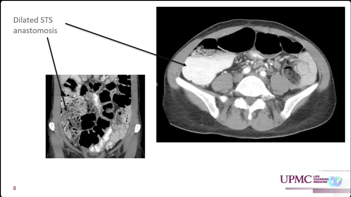 drRobinDud's tweet photo. βοΈNext importan cases during #IBDlive with Prof. @MRegueiroMD & IBD spescialists from πΊπΈ
ποΈWhen the Plans Unexpectedly Change - πΏAll Hands On Deck
Team β½οΈππβΎοΈapproach for best #IBDpatients π₯
ππ₯care
Sometimes surgery is necessary π£in further biology & nutritional treat..