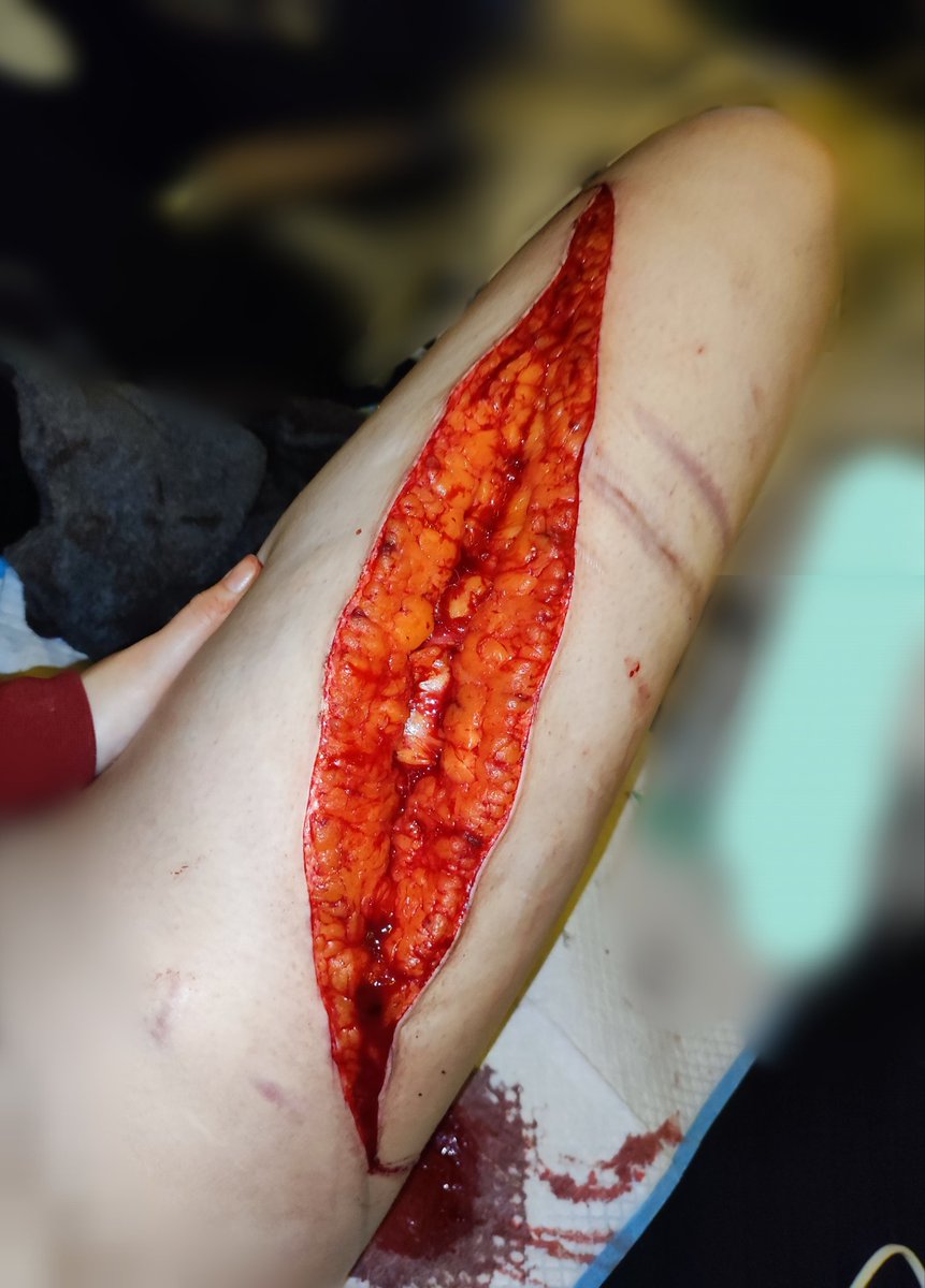 Ellie18277SH's tweet photo. TW SH

.
.
.

FAKE

.
.
.

went a bit crazy cutting today lmao muscle on the lower leg and fascia on the thigh which is the biggest cut I've ever done at 35 cm although was originally planning on doing 45cm lol https://t.co/pHIp9TMIOT