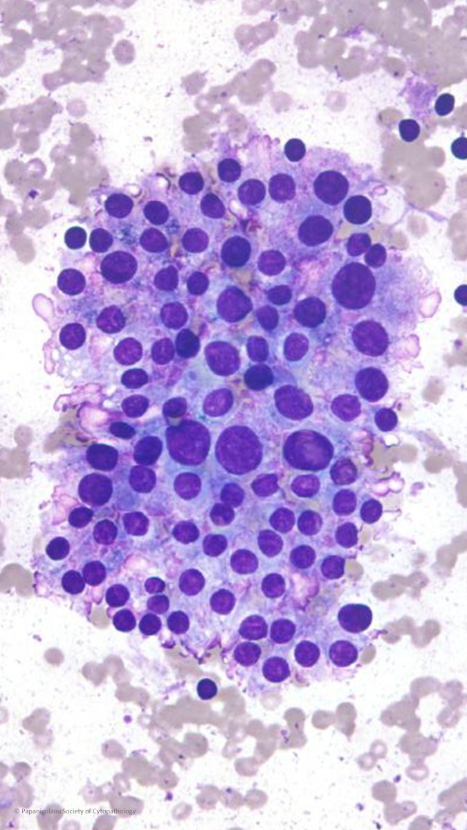 Charles Herndon (@drcyclopath) on Twitter photo FNA from a diffusely enlarged thyroid in a 30-year-old female. 
What is your interpretation?π§
A) Non-Diagnostic
B) Benign
C) Follicular neoplasm
D) Atypia of undetermined significance (AUS)
#CytoPath #PathTwitter #Pathology FNA from a diffusely enlarged thyroid in a 30-year-old female. 
What is your interpretation?π§
A) Non-Diagnostic
B) Benign
C) Follicular neoplasm
D) Atypia of undetermined significance (AUS)
#CytoPath #PathTwitter #Pathology
