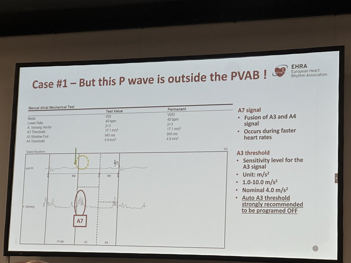 Stefan Simović (@simovicst) on Twitter photo #EHRA_ESC Advanced CIED course is off to a great start with VDD & DDD leadless pacing 🇨🇭
<a href="/HaranBurri/">Haran Burri</a> <a href="/martaderiva/">Marta de Riva</a> <a href="/MBergonti/">Marco Bergonti</a> #EHRA_ESC Advanced CIED course is off to a great start with VDD & DDD leadless pacing 🇨🇭
<a href="/HaranBurri/">Haran Burri</a> <a href="/martaderiva/">Marta de Riva</a> <a href="/MBergonti/">Marco Bergonti</a>