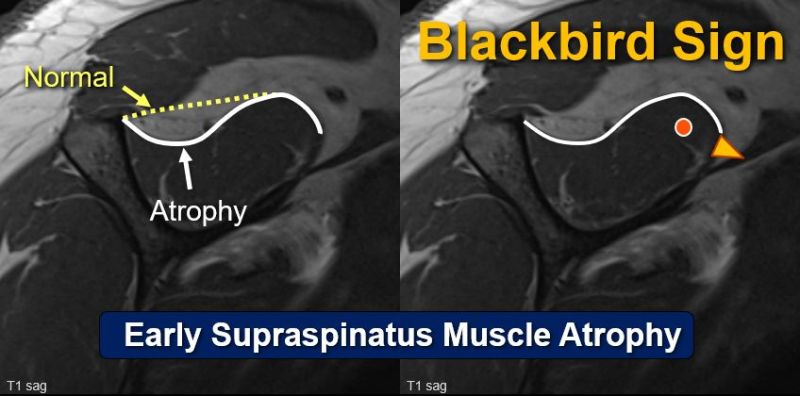 SutterBalgrist's tweet image. The #BlackbirdSign: Out now in print & #OpenAccess
👉link.springer.com/article/10.100…
This sign can identify #EarlyAtrophy of the #Supraspinatus muscle, which is an important risk factor for re-tears after tendon repair of the shoulder.
@FeuerriegelG @derbalgrist @UZH_en @EurRadiology