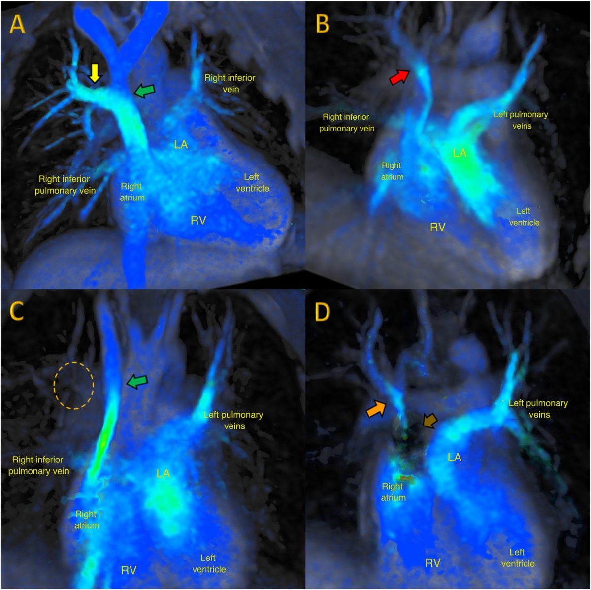 REC Publications (@revespcardiol) on Twitter photo 4D-flow cardiac magnetic resonance in repaired anomalous pulmonary venous drainage. #REC #AheadOfPrint <a href="/javierurmeneta1/">Javier Urmeneta</a> <a href="/jacabreracardio/">Dr. José Ángel Cabrera</a>
🔗 revespcardiol.org/en-d-flow-card… 4D-flow cardiac magnetic resonance in repaired anomalous pulmonary venous drainage. #REC #AheadOfPrint <a href="/javierurmeneta1/">Javier Urmeneta</a> <a href="/jacabreracardio/">Dr. José Ángel Cabrera</a>
🔗 revespcardiol.org/en-d-flow-card…