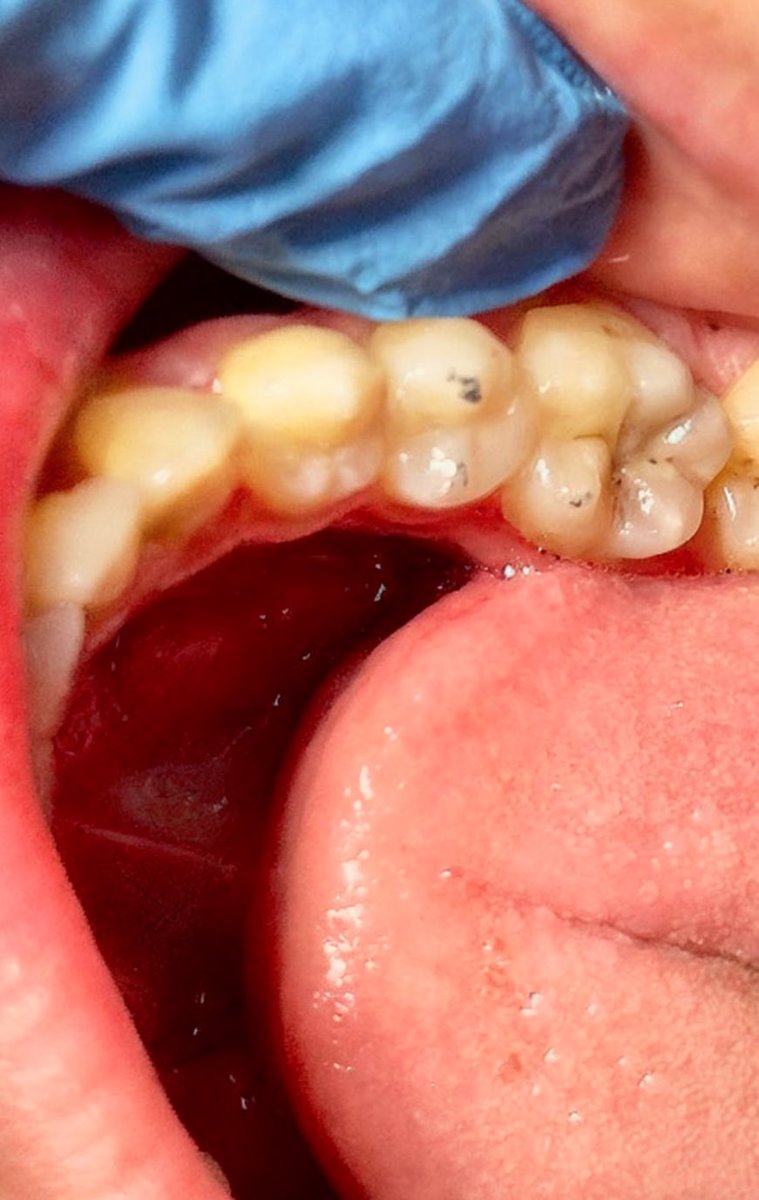 Class II on #45 Distally 🫧