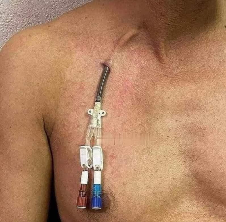 Nutri_Hero's tweet photo. Durante la hemodiálisis, la sangre sale por un tubo rojo, pasa por la máquina y regresa por un tubo azul. 4 horas, 3 veces a la semana, 48 horas al mes. Para muchos, los riñones lo hacen solos 36 veces al día.
💙 Cuida tus riñones.
#SaludRenal #Hemodiálisis #Prevención #nutrihero https://t.co/2WOEfNnugU