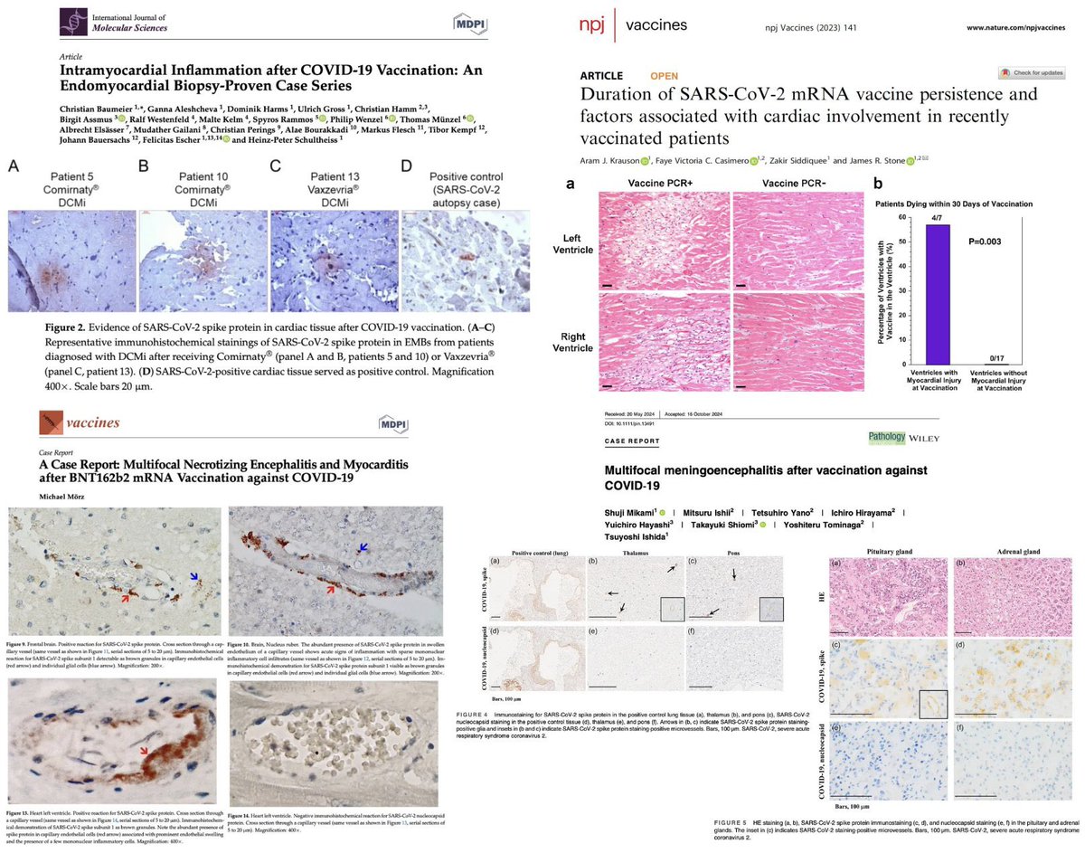 COVID-19 "vaccinated" individuals are sicker because the lipid nanoparticles (LNPs) carrying modified mRNA travel to their vital organ systems, instructing them to become toxic full-length, prefusion-stabilized Spike protein factories.