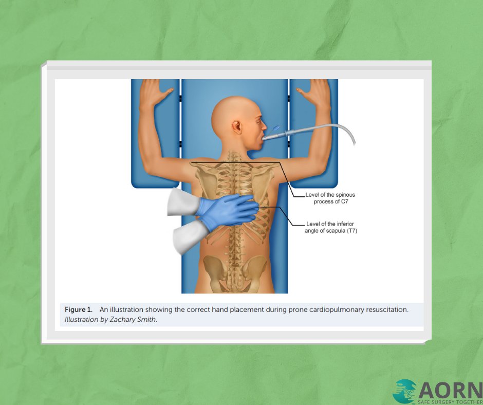 A Comparative Study of Time to Initiate Chest Compressions and Chest Compression Fraction in the Supine and Prone Positions Using Simulation
aornjournal.onlinelibrary.wiley.com/doi/10.1002/ao… 

#AORNJournal #PerioperativeNurses #Nursing #NurseLife #OperatingRoomNurses