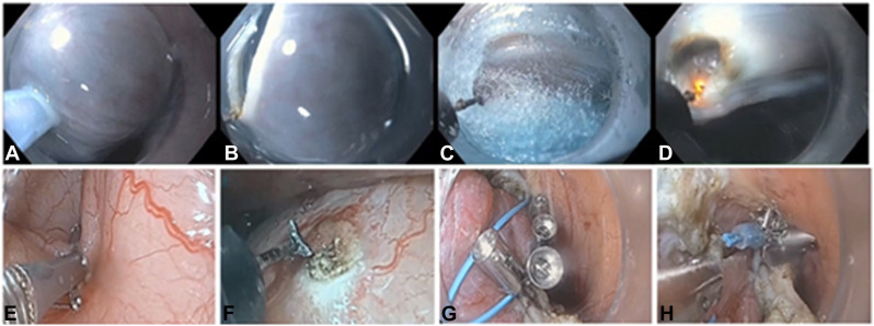 iGIE (@igiejournal) on Twitter photo In iNNOVATIONS: iMAGES in iGIE: Matar et al engage in "Enhancing peritoneal visualization in peroral endoscopic myotomy with fundoplication using novel robotic peritoneal pressure optimization." igiejournal.org/article/S2949-ā¦
<a href="/MouenKhashab/">Mouen Khashab, MD, MASGE</a> <a href="/MetabolicEndo/">Chris Thompson, MD</a> <a href="/gutdoc18/">Janese Laster, MD</a> In iNNOVATIONS: iMAGES in iGIE: Matar et al engage in "Enhancing peritoneal visualization in peroral endoscopic myotomy with fundoplication using novel robotic peritoneal pressure optimization." igiejournal.org/article/S2949-ā¦
<a href="/MouenKhashab/">Mouen Khashab, MD, MASGE</a> <a href="/MetabolicEndo/">Chris Thompson, MD</a> <a href="/gutdoc18/">Janese Laster, MD</a>