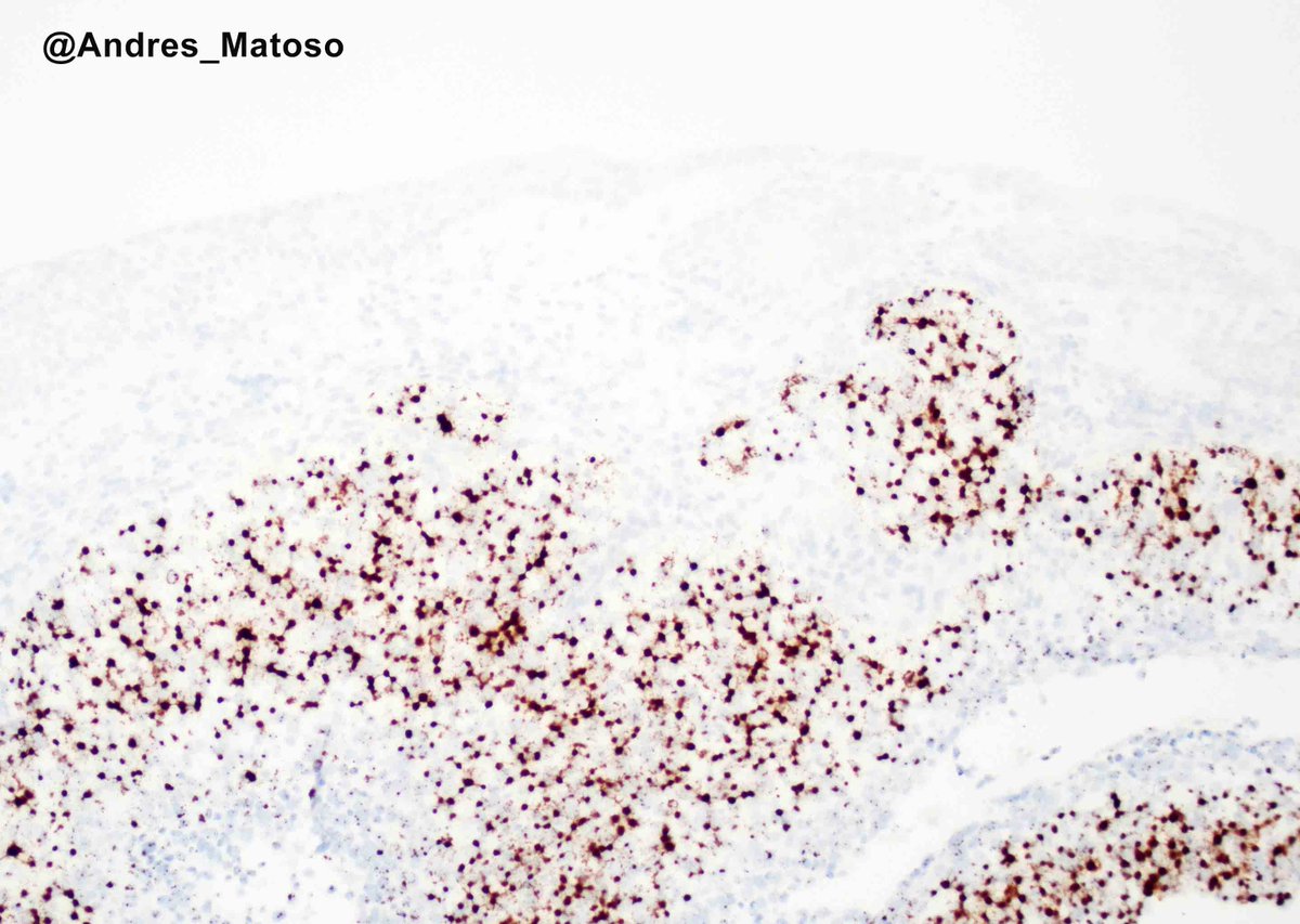Basaloid squamous cell carcinoma can mimic urothelial carcinoma, so it's crucial to identify the overlying benign urothelium. While IHC for p16 is not helpful in distinguishing between the two, HPV-HR ISH, if positive, is diagnostic of squamous cell carcinoma. #GUpath