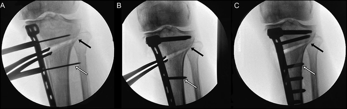Exploring the latest research: Intraoperative Complications in Medial Opening Wedge High Tibial Osteotomy. bit.ly/40YKrhL