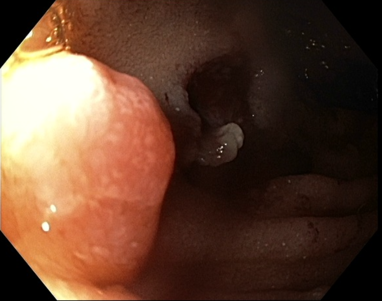 BaystateAdvEndo's tweet photo. Young patient with FAP with small but biopsy proven ampullary adenoma. ERCP with ampullectomy was performed successfully at Baystate Medical Center. We do ~ 10 ampullectomy cases per year @BaystateAdvEndo What is your approach for those polyps? #GITwitter @DouglasAdlerMD Do you do Biliary and Pancreatic sphincterotomy first? Do you resect then try to find the PD or find the PD then resect? @JohnMil10501740 @nha_duongDO @kais_zakharia