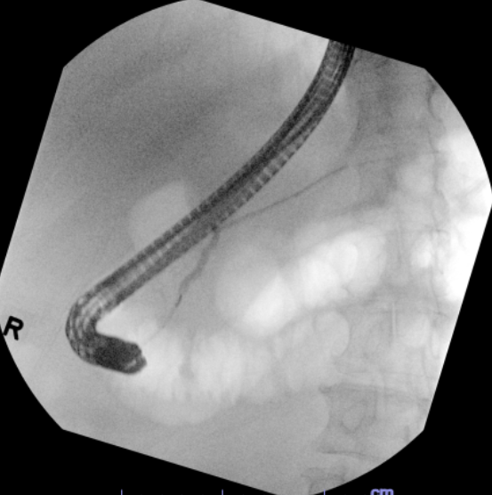 Young patient with FAP with small but biopsy proven ampullary adenoma. ERCP with ampullectomy was performed successfully at Baystate Medical Center. We do ~ 10 ampullectomy cases per year <a href="/BaystateAdvEndo/">Baystate Advanced Endoscopy</a> What is your approach for those polyps? #GITwitter <a href="/DouglasAdlerMD/">Douglas G. Adler MD, FASGE, FACG, AGAF</a> Do you