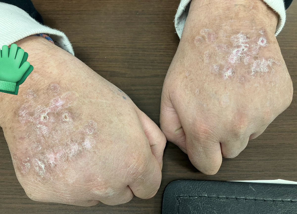 10Ketamine's tweet image. 👨🏻‍⚕️Cet après-midi en consultation, 🧔‍♂️B.42 ans, injecteur, vient en consultation de suivi pour renouvellement traitement de substitution méthadone:
🧔‍♂️ « là ça devient bon, doc. Regardez! 
2 mois sans aiguilles. Ça cicatrise gentiment. J’avais plus de veines »
#MotsDePatient 
#PWID