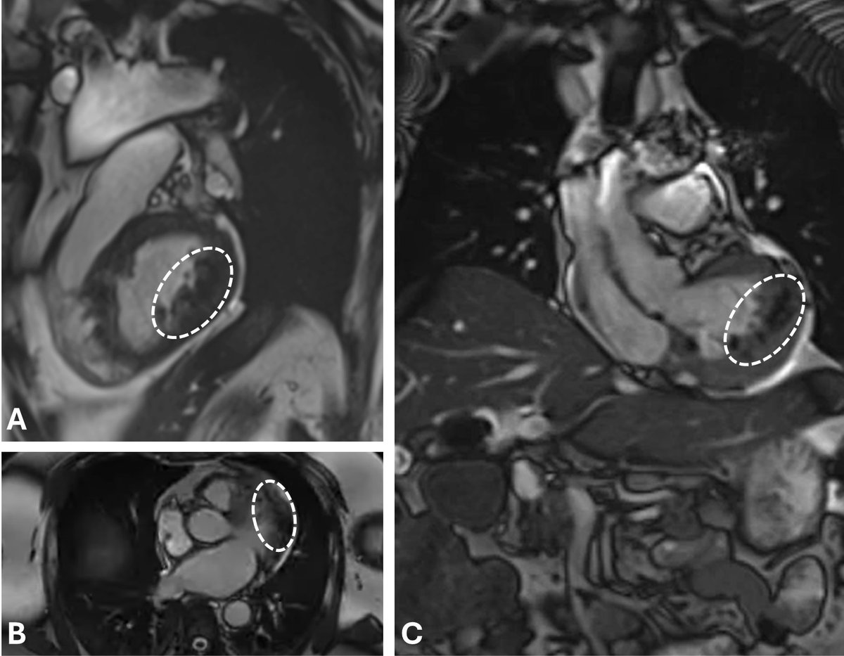 DeBakeyCVedu's tweet photo. #DeBakeyCVJournal case! “Heart of Stone: Rare Case of Incidentally Detected Endocardial Calcification" by Vaibhav Sharma, Vishakha Maheshwari &amp; Biswajit Kar @UTHealthHouston

Videos &amp; more https://t.co/XoAkYpTMQO 
@CardioNerds @HMethodistCV @maquinonesmd @NadeenFaza #CardioEd https://t.co/idpAEpQv3X