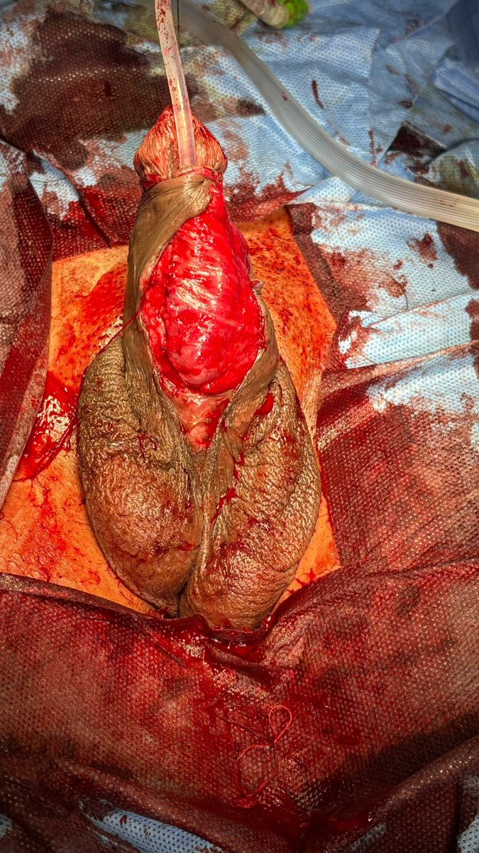 Pankaj M Joshi (@drjoshi_pankaj) on Twitter photo Failed Bracka BMG Hypospadias repair . Graft contracted .
Dorsal penile flap for such challenging cases. Excellent outcomes .
youtu.be/ShDtmT02XFA
<a href="/SocietyGURS/">GURS</a> <a href="/ISORU1/">ISORU</a> <a href="/SIU_Journal/">Société Internationale d'Urologie Journal</a> <a href="/USANZUrology/">USANZ</a> <a href="/BJUIjournal/">BJU International</a> Failed Bracka BMG Hypospadias repair . Graft contracted .
Dorsal penile flap for such challenging cases. Excellent outcomes .
youtu.be/ShDtmT02XFA
<a href="/SocietyGURS/">GURS</a> <a href="/ISORU1/">ISORU</a> <a href="/SIU_Journal/">Société Internationale d'Urologie Journal</a> <a href="/USANZUrology/">USANZ</a> <a href="/BJUIjournal/">BJU International</a>