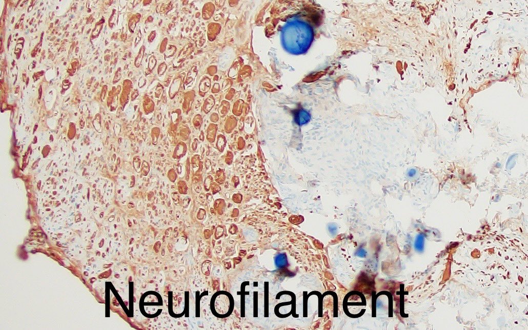 We talk about #brain invasion a lot with meningiomas, but it’s not often you see peripheral nerve invasion, like in this spinal #meningioma. #neuropath #PathX 🧠🔬