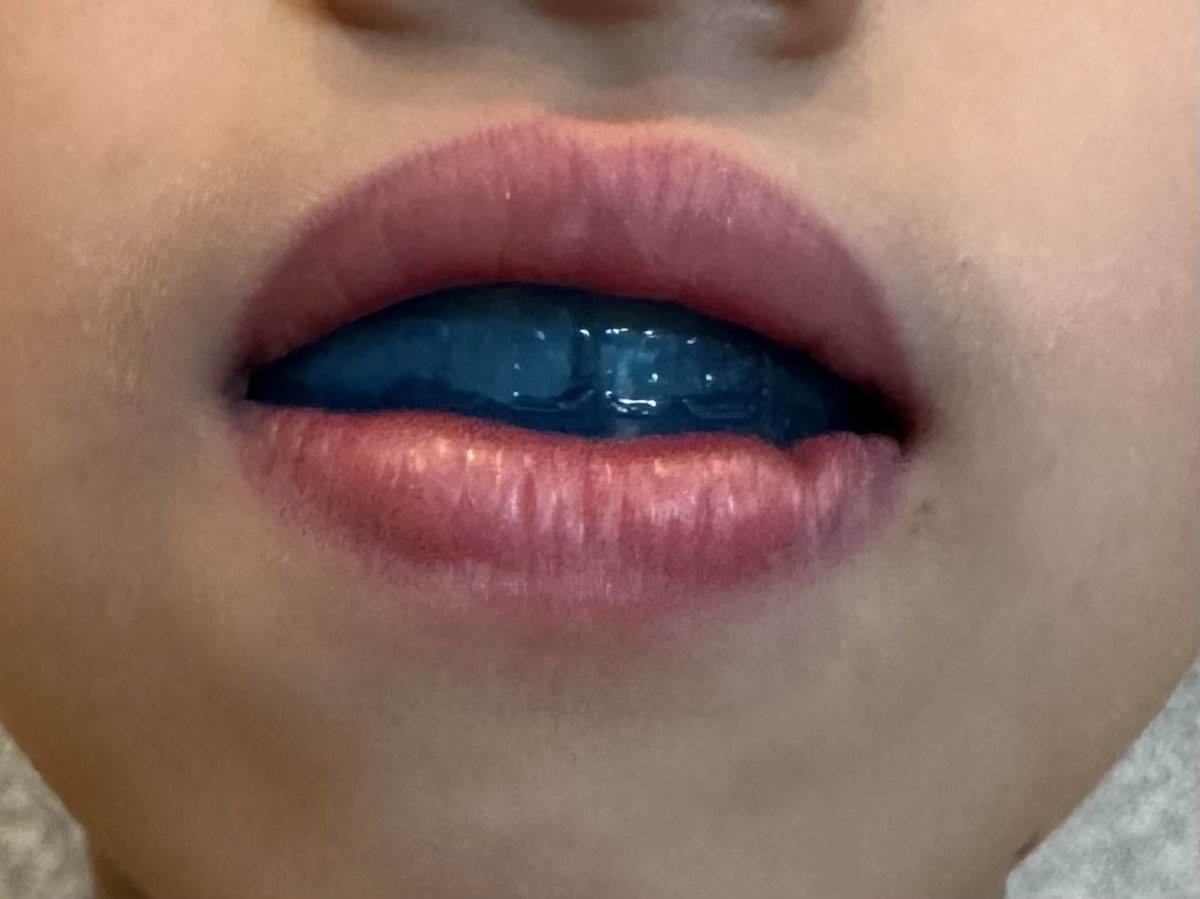 dds_cozy's tweet image. うちの子、舌癖・口呼吸・鼻詰まりを治すために、寝るときの装置に挑戦中。
なかなか朝までつけられなかったけど…ついに今朝、初めて朝まで入れられた！！

子供も大喜びで、まじ記念日！！