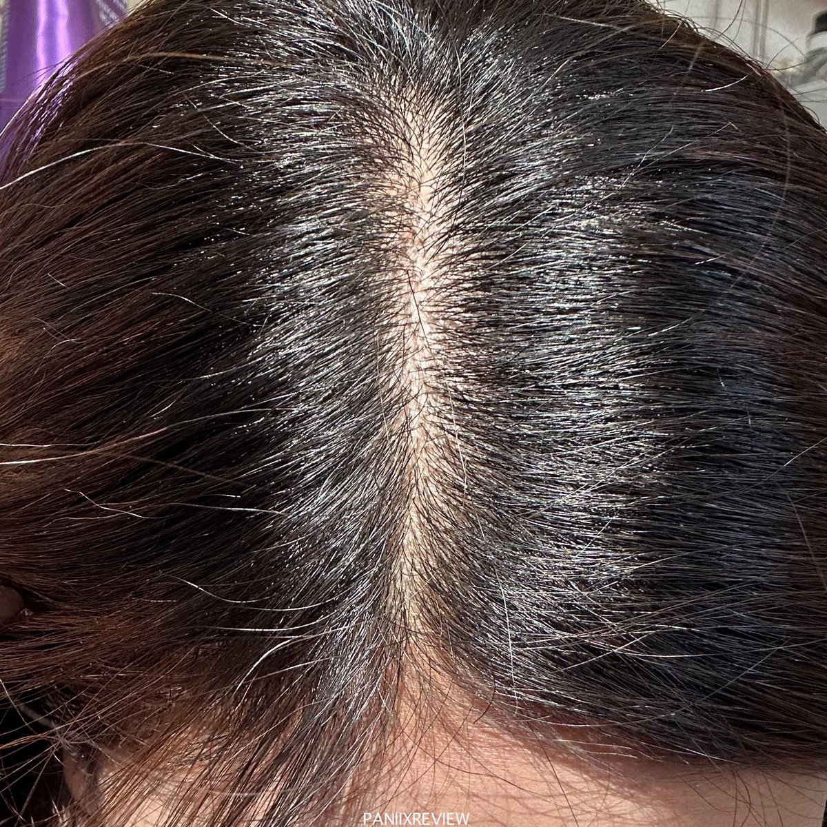 ขวดสองหมด ขวดสามเตรียมเปิดใช้แล้ว 🧴✨ Vichy Dercos คือช่วยลดรังแค ลดความมันได้ดีมากจริง นี่มีปัญหาหลังทำสีผมรอยล่าสุดผมมันไว คันไว เกาแล้วแอบเป็นขุยๆ ตั้งแต่ใช้ก็คือจบปัญหาหัวมัน หัวเป็นขุย รังแค ตอนสระฟองเยอะ กลิ่นไม่เหม็นยา ตัวนี้แนะนำคับ #ใช้ดีบอกต่อ https://t.co/iBZJS54we9
