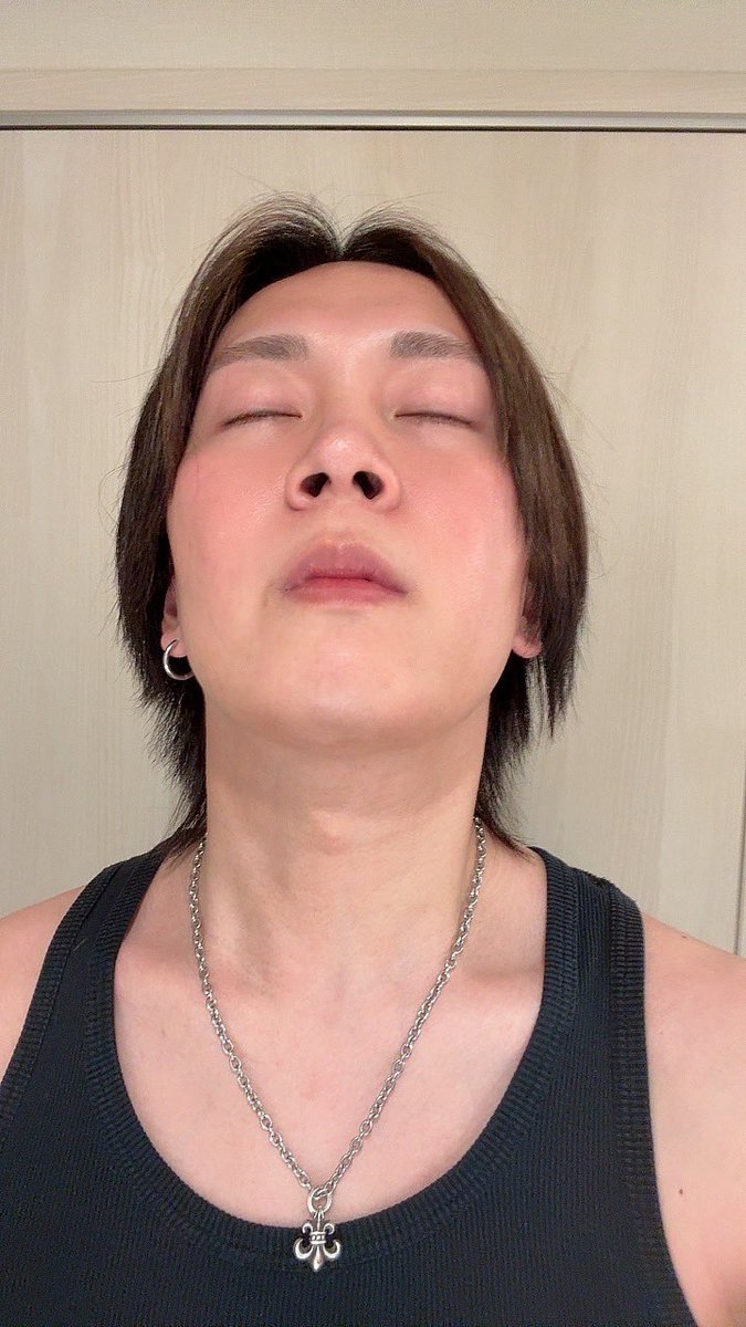 jin_623_'s tweet photo. 〜ダウンタイム6ヶ月経過〜

遂に半年経過して輪郭が割と出てきた！
向く角度によっては二重顎になるけど…
両顎手術したら仕方ないって聞くしそこはやっぱりリフトアップとか考えないとなのかな🤔
まだまだこれからが楽しみ！

#id美容外科 #韓国整形 #骨切り
#両顎手術 #Vライン形成
#ルフォー #ssro https://t.co/n9nZUu19Y0