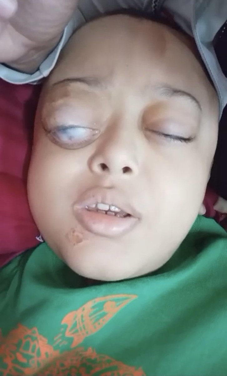 Taoro8's tweet photo. La Dictadura cubana ha negado el documento necesario para recibir una Visa Humanitaria de los EEUU y ser operado en Miami al niño Damir Ortiz de 10 años, quien presenta un neurofibroma plexiforme en el ojo derecho y daño renal.
@UNICEF @ONU_es @MINSAPCuba @SecRubio @DiazCanelB https://t.co/XlBQFypzSC