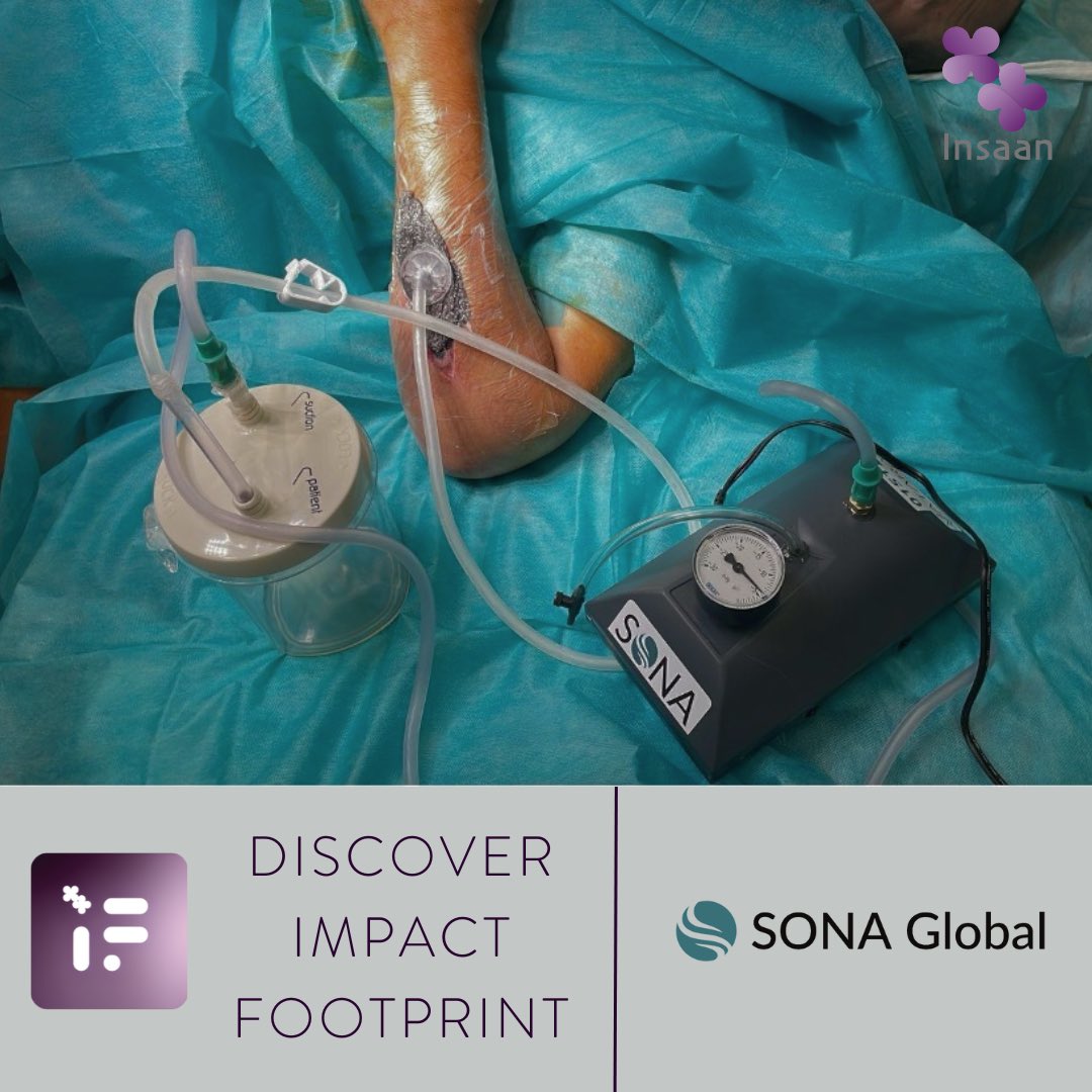 Insaan Group (@theinsaangroup) on Twitter photo 💡Today on ‘Discover Impact Footprint’, we are showcasing <a href="/SONAGlobalOrg/">SONA Global</a>.
Sona Global addresses the disproportionate effect of open fractures in low-middle income countries by creating affordable market-driven medical devices and training for surgeons.
impactfootprint.org 💡Today on ‘Discover Impact Footprint’, we are showcasing <a href="/SONAGlobalOrg/">SONA Global</a>.
Sona Global addresses the disproportionate effect of open fractures in low-middle income countries by creating affordable market-driven medical devices and training for surgeons.
impactfootprint.org