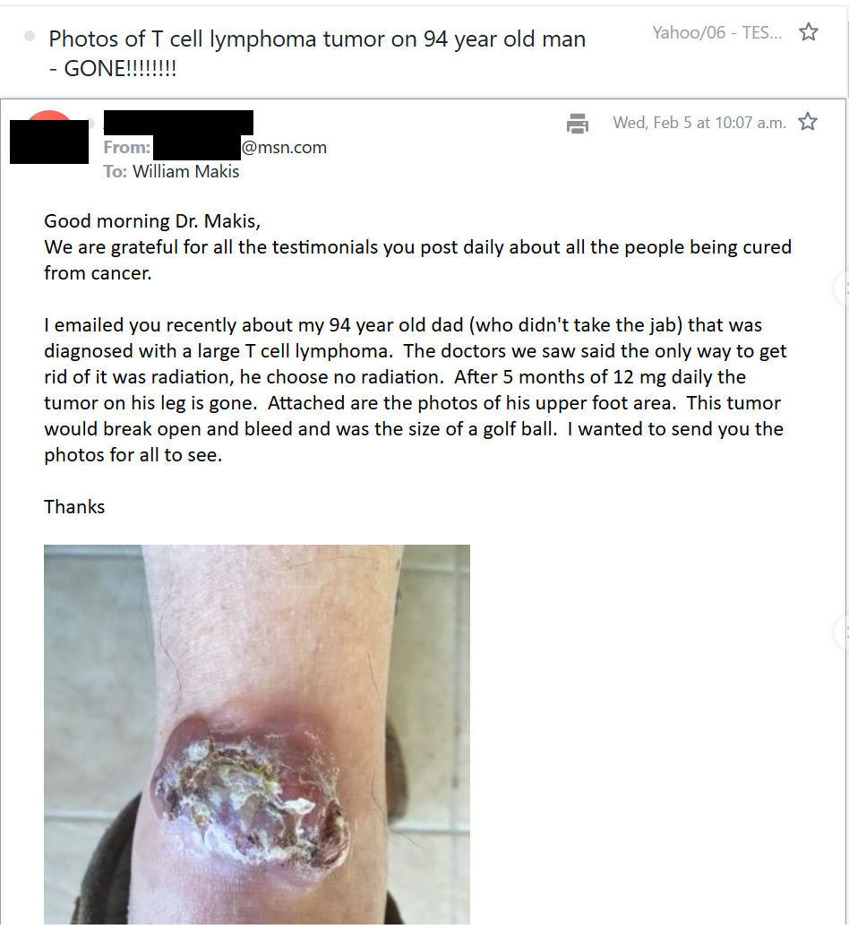 MakisMedicine's tweet photo. NEW ARTICLE: IVERMECTIN Testimonial - 94 year old man with Large T-Cell Lymphoma and a mass on his foot refused radiation (before and after photos included!)

"My father is 94 years old and was diagnosed with large T cell lymphoma. He had a golf ball sized tumor on the top of his foot at the bend of his foot. All the doctors he saw said it wouldn't go away without radiation." 

"At his age he chose not to do that. I talked him into trying Ivermectin. I started him on the 1mg/per kilogram as you suggested but my siblings fought me and said that was too much for him to take."

"He has been taking 12mg for the last five months and his tumor is now smaller than a pea and it hasn't been breaking open and bleeding like it had been."

"We are thrilled with the progress even the low dose of ivermectin has achieved."

"Thanks for everything you are doing to help people all around the world" 😃

I love my patients!!! 

No chemo. No immunotherapy. No radiation.

Just. Ivermectin. 12mg. 

@VPrasadMDMPH, delete your account. Your attack on Ivermectin failed. 

This time, I will let the pictures do all the talking!

Article Link in photo to avoid shadowban, just re-type the URL in the first photo at the top, into your browser to access.

@JoeRogan