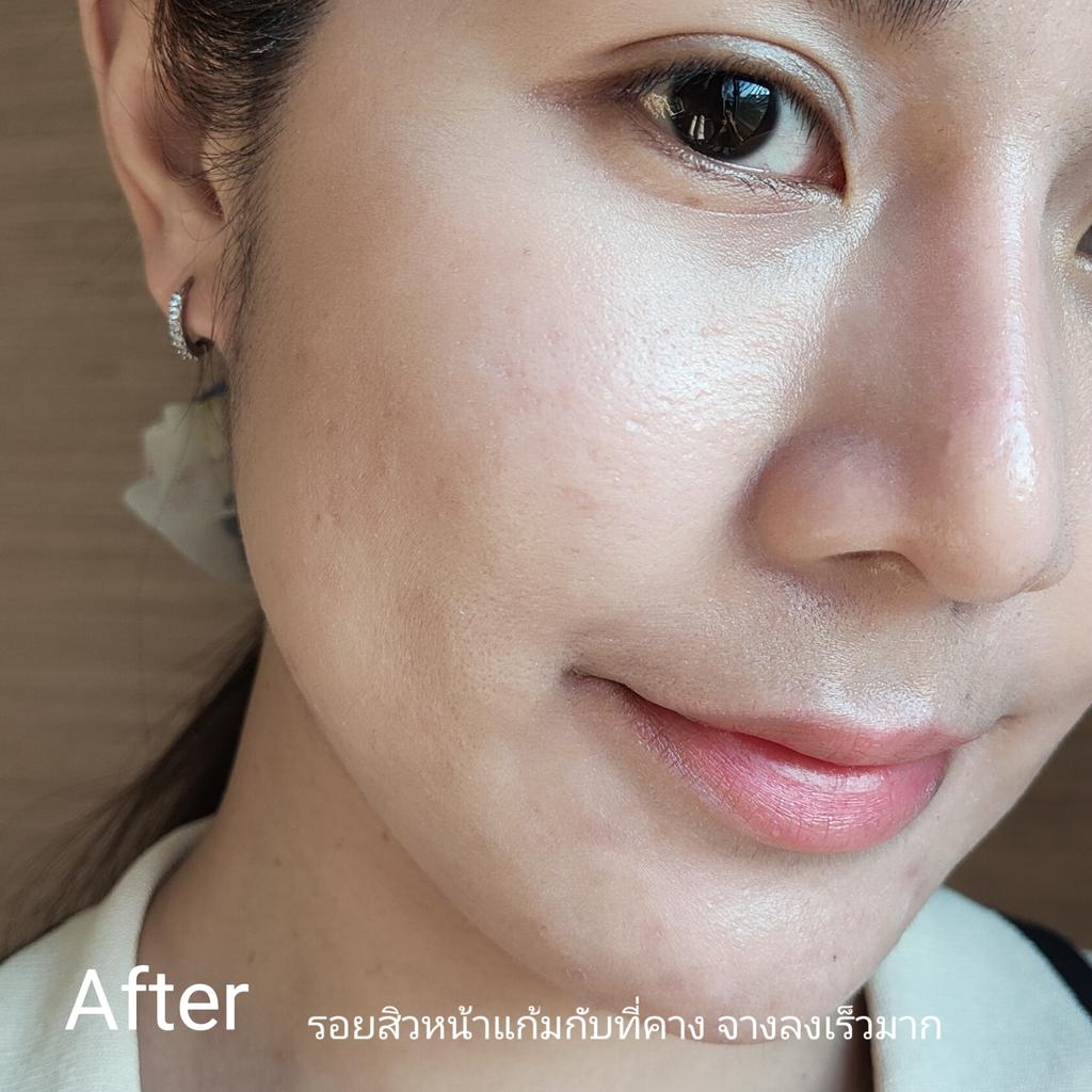 นี่พูดจากใจจริง Eucerin ไลน์สิวเค้าใช้ดีมาก ยิ่งใช้คู่กันสองตัวเซรั่มกับเจลโฟมล้างหน้านะ โคตรดี!! #EucerinTripleEffectSerum 
มี Salicylic Acid ที่แพทย์ผิวหนังแนะนำ ช่วยคุมมันละลายสิวอุดตัน + Thiamidol ลดรอยสิว ยับยั้งการเกิดรอยสิวให้สิวแห้งยุบ ลดรอยสิวไปในตัวเลย ไม่ต้องหาครีมลดรอยสิวมาเพิ่มแล้ว  #EucerinGeltoFoam เจลโฟมล้างหน้าตัวนี้ชะล้างสิ่งอุดตันใต้ผิวดีมาก ฆ่าเชื้อแบคทีเรีย นอกจากช่วยให้สิวลดลง สิวใหม่ก็น้อยลง รอยสิวก็จางไว ล้างแล้วหน้าไม่เอี๊ยดยังนุ่มเหมือนเดิม แค่ 2 ตัวนี้เลย รับรองสิวหายแน่นอน

ใครเป็นสิว+รอยสิวเราแนะนำให้อดทนรักษา ค่อยเป็นค่อยไป ลดตัวกระตุ้นการเกิดสิวต่างๆ ลองสังเกตว่าแพ้อะไร และรักษาสิว เสริมผิวให้แข็งแรง แค่นี้เลย รับรองผิวกลับมาดีเหมือนเดิมแน่นอน #EucerinThailand #จบทุกสิวและรอยสิวซ้ำซาก #รักษาสิว