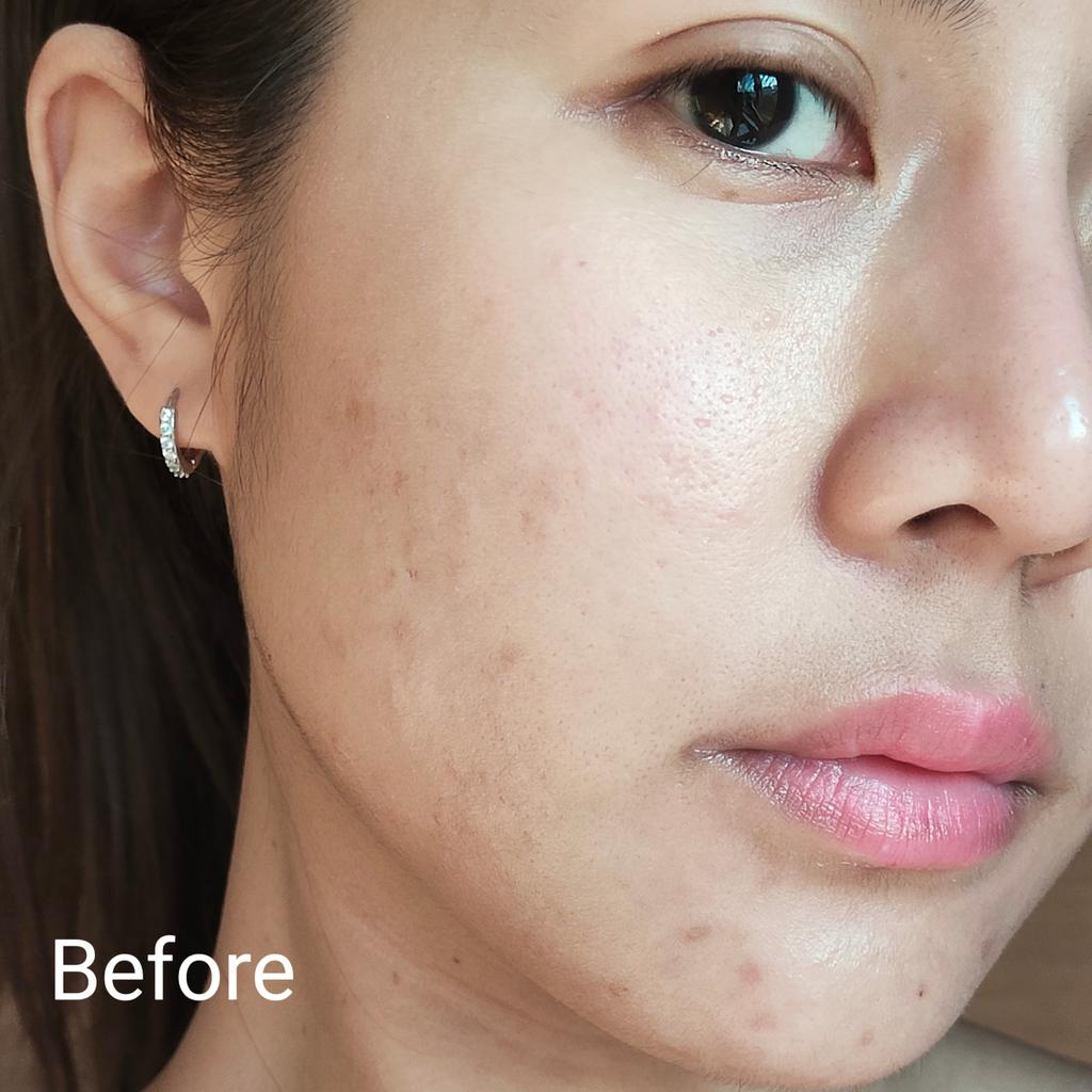 นี่พูดจากใจจริง Eucerin ไลน์สิวเค้าใช้ดีมาก ยิ่งใช้คู่กันสองตัวเซรั่มกับเจลโฟมล้างหน้านะ โคตรดี!! #EucerinTripleEffectSerum 
มี Salicylic Acid ที่แพทย์ผิวหนังแนะนำ ช่วยคุมมันละลายสิวอุดตัน + Thiamidol ลดรอยสิว ยับยั้งการเกิดรอยสิวให้สิวแห้งยุบ ลดรอยสิวไปในตัวเลย ไม่ต้องหาครีมลดรอยสิวมาเพิ่มแล้ว  #EucerinGeltoFoam เจลโฟมล้างหน้าตัวนี้ชะล้างสิ่งอุดตันใต้ผิวดีมาก ฆ่าเชื้อแบคทีเรีย นอกจากช่วยให้สิวลดลง สิวใหม่ก็น้อยลง รอยสิวก็จางไว ล้างแล้วหน้าไม่เอี๊ยดยังนุ่มเหมือนเดิม แค่ 2 ตัวนี้เลย รับรองสิวหายแน่นอน

ใครเป็นสิว+รอยสิวเราแนะนำให้อดทนรักษา ค่อยเป็นค่อยไป ลดตัวกระตุ้นการเกิดสิวต่างๆ ลองสังเกตว่าแพ้อะไร และรักษาสิว เสริมผิวให้แข็งแรง แค่นี้เลย รับรองผิวกลับมาดีเหมือนเดิมแน่นอน #EucerinThailand #จบทุกสิวและรอยสิวซ้ำซาก #รักษาสิว