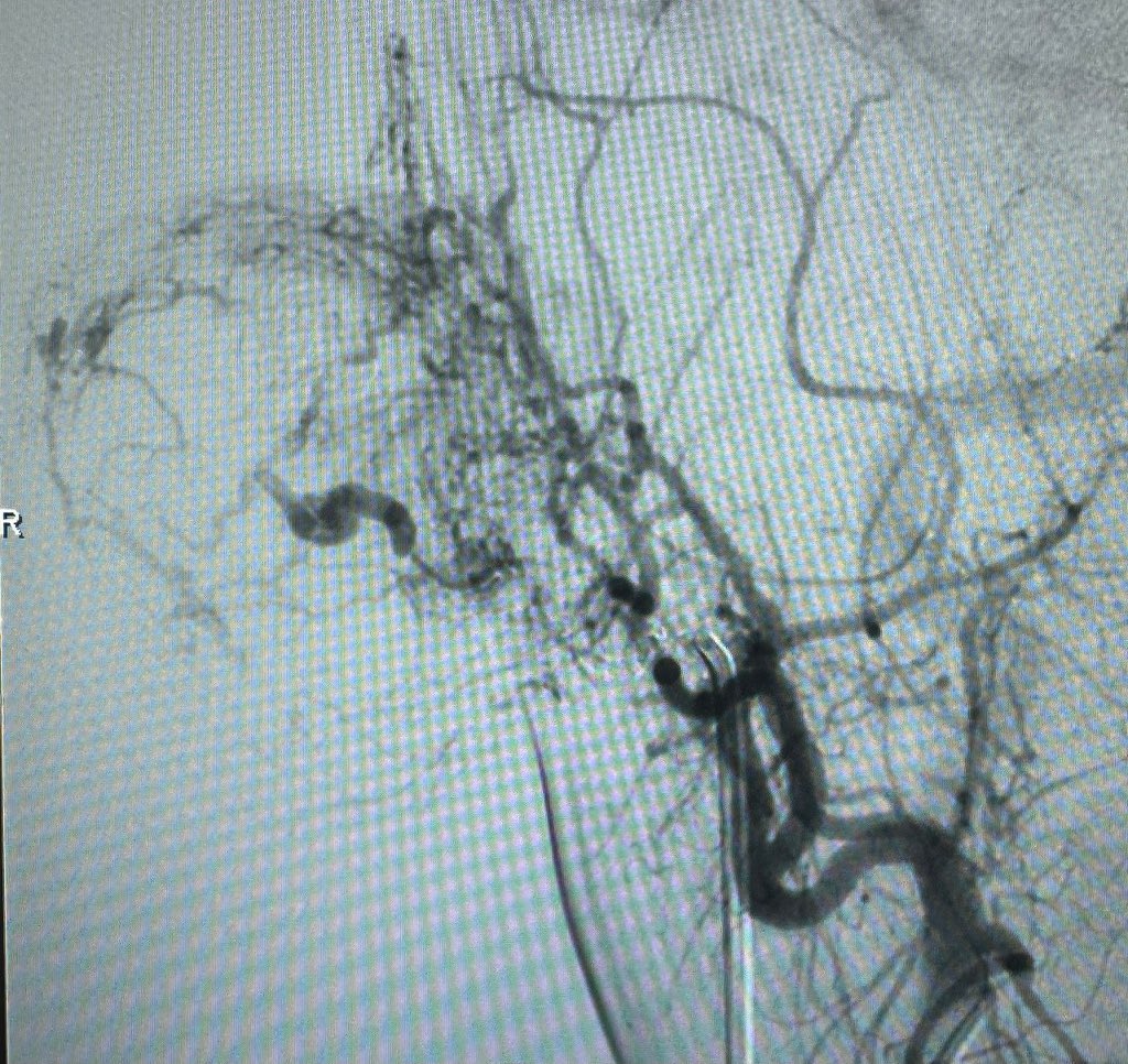 🚀 Advancing Neurointerventional Radiology at Muhimbili! 🇹🇿 

This week, we welcomed Dr. Horikawa 🇯🇵 from the Dotter Institute 🇺🇸, collaborating on cutting-edge Neuro-IR cases, including embolization of an auricular vascular malformation.

Pushing boundaries, improving lives!