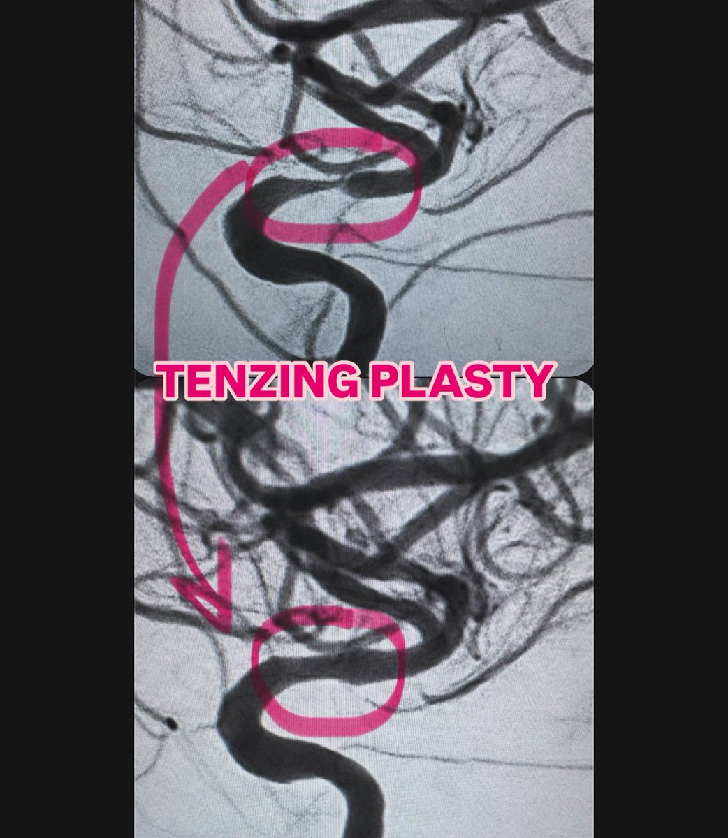 Amanda Baker, MD (@amandaebaker) on Twitter photo Have I mentioned how much I 💜 <a href="/route92med/">Route 92 Medical</a> for saving me from risky balloon angioplasty of chronic #ICAD for #strokeintervention ? <a href="/Monte_NIS/">Montefiore Neurointerventional Surgery</a> <a href="/MontefioreRAD/">Montefiore Radiology</a> <a href="/MonteNeurosg/">MMC/AECOM Neurosurg</a> <a href="/NeuroMonteEinst/">Montefiore-Einstein Neurology</a> <a href="/MontefioreNYC/">Montefiore Health System</a> Have I mentioned how much I 💜 <a href="/route92med/">Route 92 Medical</a> for saving me from risky balloon angioplasty of chronic #ICAD for #strokeintervention ? <a href="/Monte_NIS/">Montefiore Neurointerventional Surgery</a> <a href="/MontefioreRAD/">Montefiore Radiology</a> <a href="/MonteNeurosg/">MMC/AECOM Neurosurg</a> <a href="/NeuroMonteEinst/">Montefiore-Einstein Neurology</a> <a href="/MontefioreNYC/">Montefiore Health System</a>
