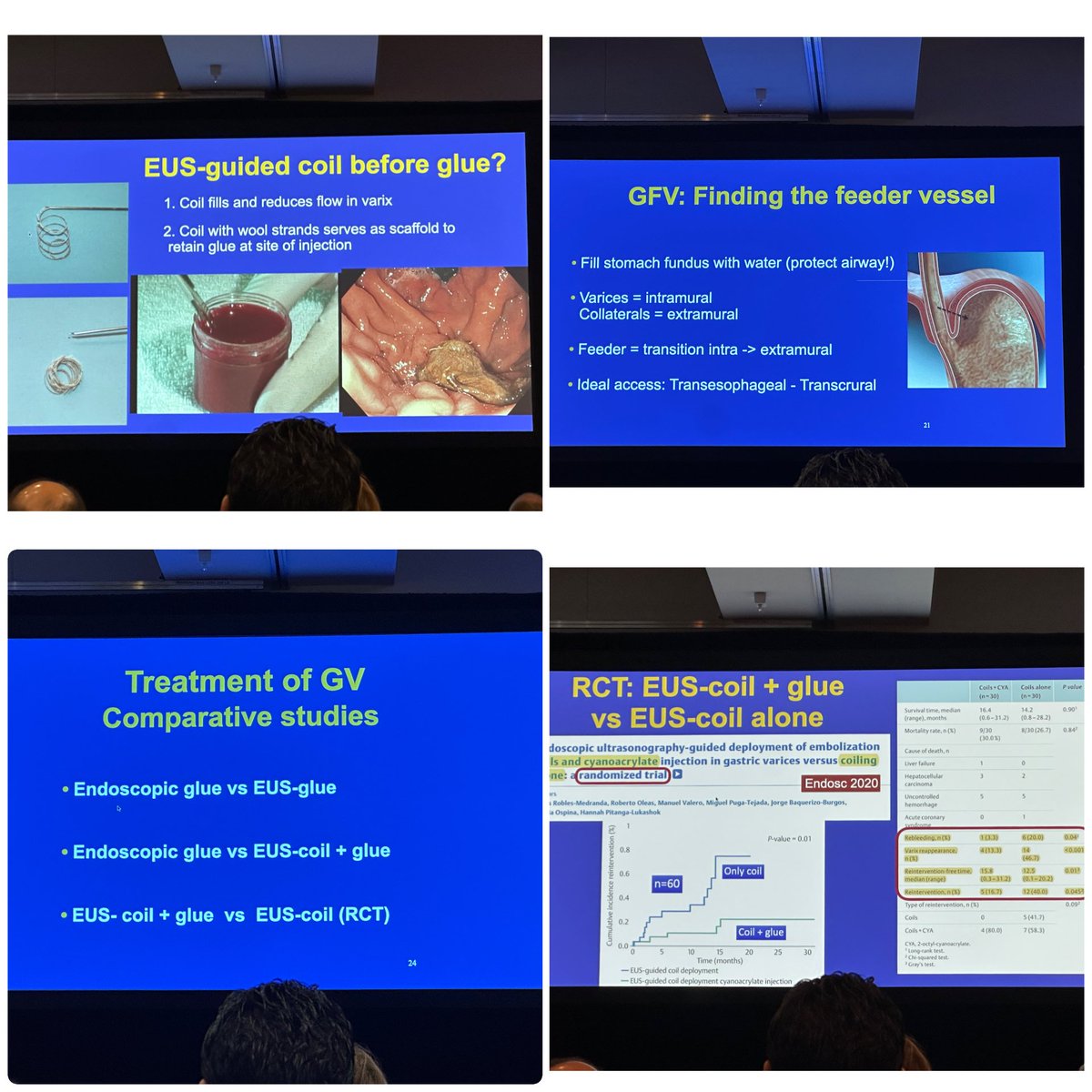 #OLE2025 is incomplete without Prof. BinMoeller’s legendary session on #GastricVarices. The GI genius of advanced endoscopy returns with more groundbreaking insights! #GIInnovation”