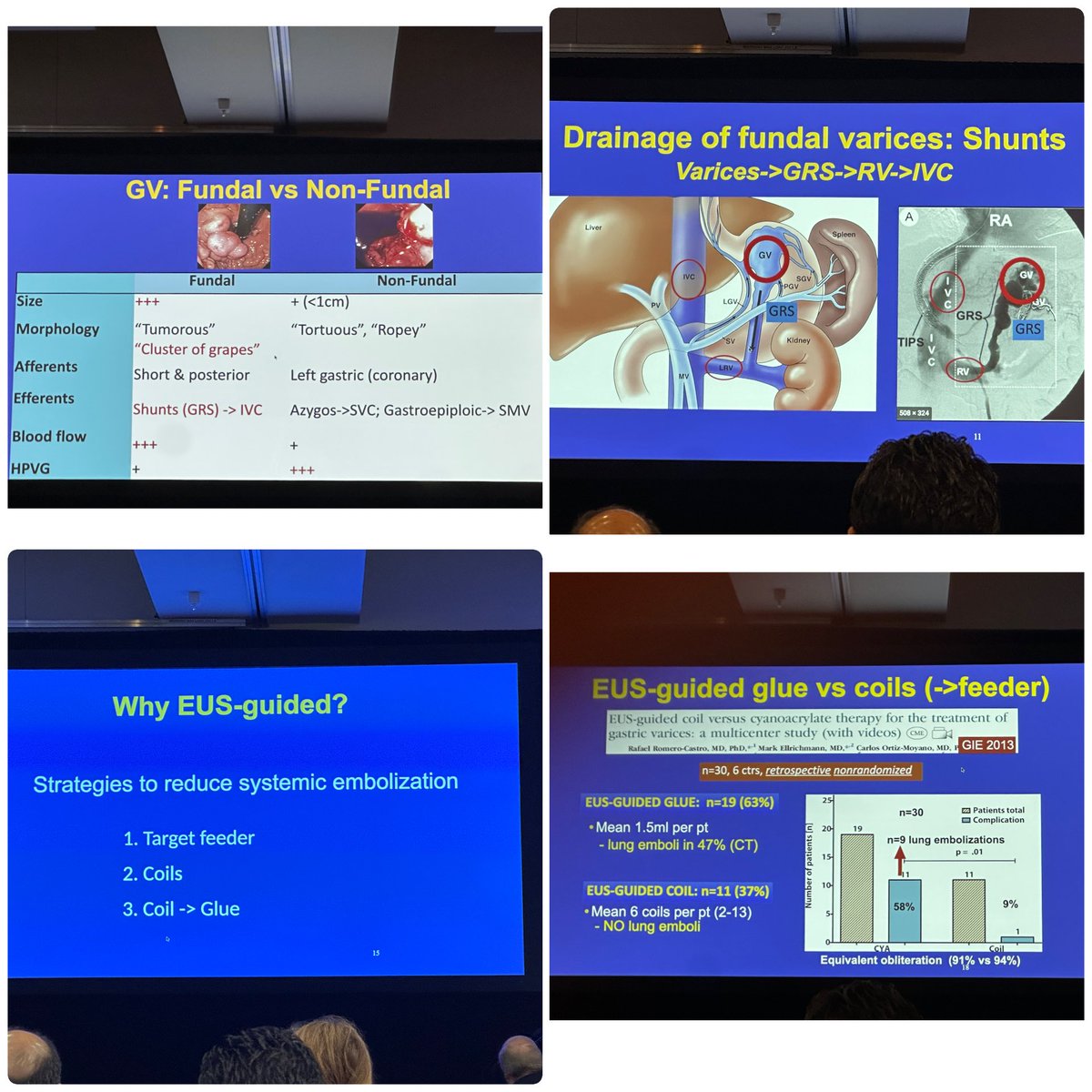 SyedGerdezi's tweet photo. #OLE2025 is incomplete without Prof. BinMoeller’s legendary session on #GastricVarices. The GI genius of advanced endoscopy returns with more groundbreaking insights! #GIInnovation” https://t.co/jSX0n0v33P