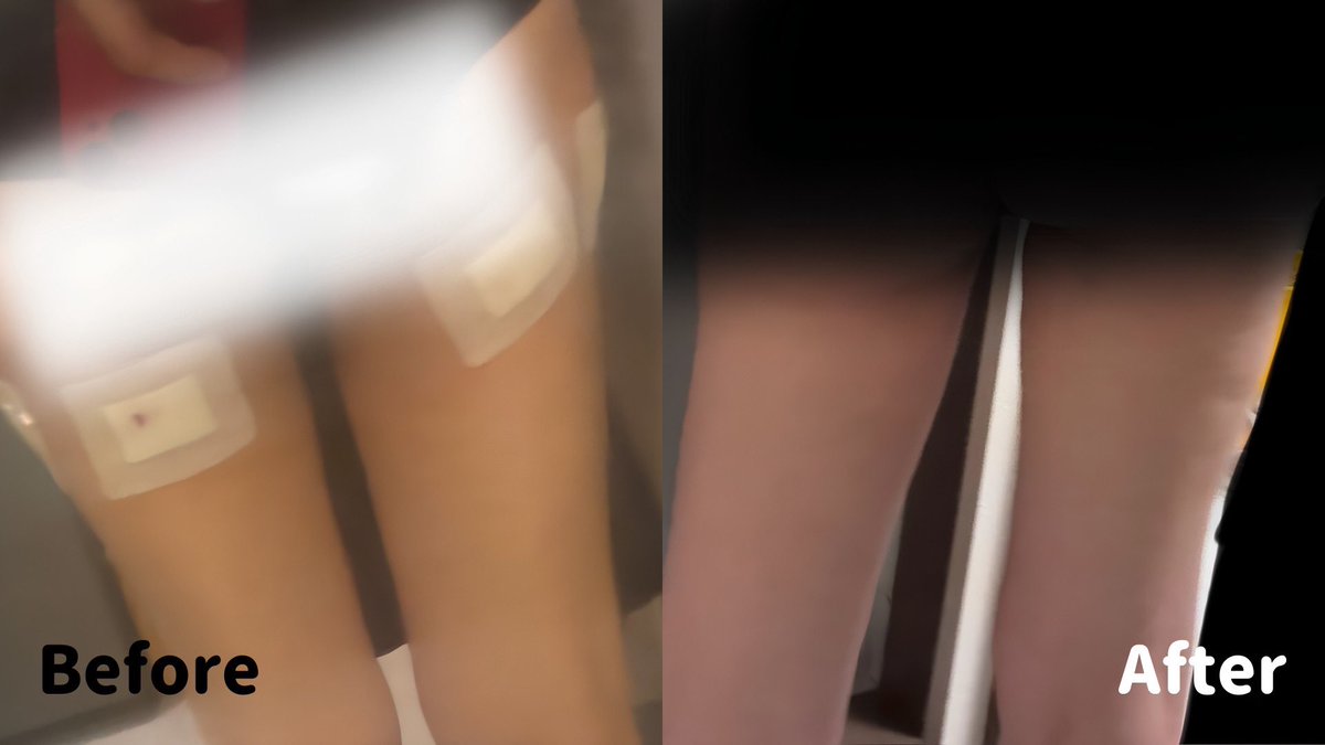 遅くなったけどペッ注射約10日経過の写真💉
太もも横とお尻下にしたけど
太もも横が明らかに細くなった感ある！
1回でも効果全然感じれた～！

Before↓　　　　　　　　After↓