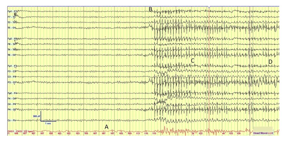 1/
A 37 yo W is in the ED after an event of unresponsiveness. She’s had a 3y h/o eye fluttering, stuttering, head shaking, bilateral arm jerking movements, and unresponsiveness.

She is now back to baseline. An EEG is obtained and captures an event. What do you think is going on?