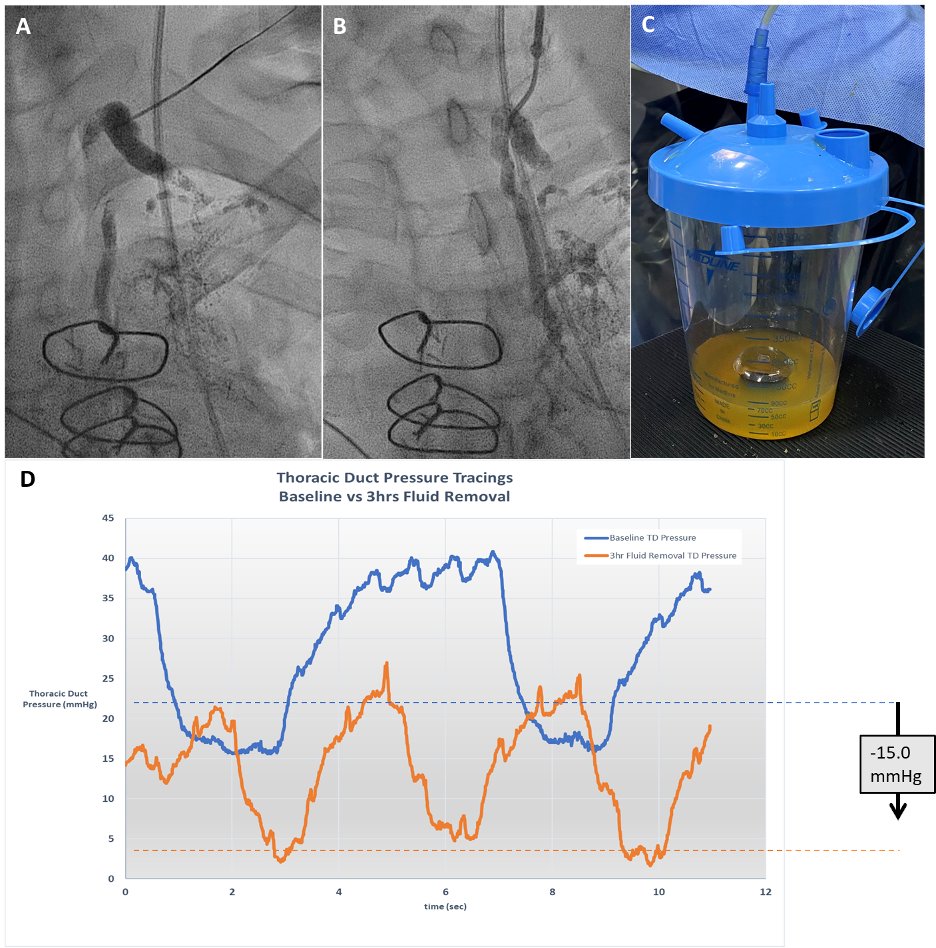 Marat Fudim, MD MHS (@fudimmarat) on Twitter photo 🧵1/ Can we tap into the lymphatic system to relieve congestion in heart failure (HF)? A new feasibility study explores thoracic duct (TD) drainage as a novel decongestive strategy in HF. Let’s dive in!
<a href="/HusamSalah/">Husam Salah</a> <a href="/khalifaa_Abu/">Abubaker Khalifa</a> <a href="/JanBiegus/">Jan Biegus</a> <a href="/ppponikowski/">Piotr Ponikowski</a>
doi.org/10.1007/s12265… 🧵1/ Can we tap into the lymphatic system to relieve congestion in heart failure (HF)? A new feasibility study explores thoracic duct (TD) drainage as a novel decongestive strategy in HF. Let’s dive in!
<a href="/HusamSalah/">Husam Salah</a> <a href="/khalifaa_Abu/">Abubaker Khalifa</a> <a href="/JanBiegus/">Jan Biegus</a> <a href="/ppponikowski/">Piotr Ponikowski</a>
doi.org/10.1007/s12265…