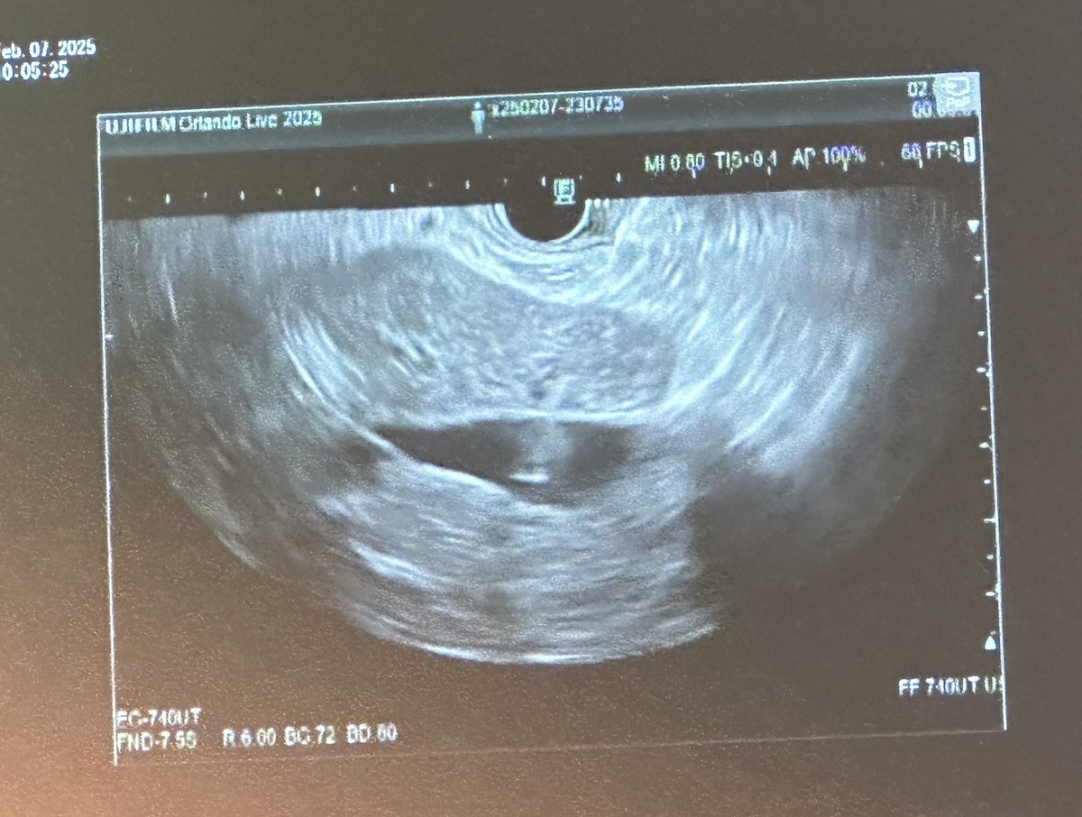 “#Endohepatology “ transforms liver diagnostics! 

🎯EUS Elastography, EUS-PPG, and liver biopsy offer a one-stop solution when standard tools fall short. 
The DFI lighting up the liver was ☠️.
🔥stellar demonstration by <a href="/helpatologist/">Nadeem Tehami</a>  &amp; Kenneth Chang. 

 #EUS #OLE2025