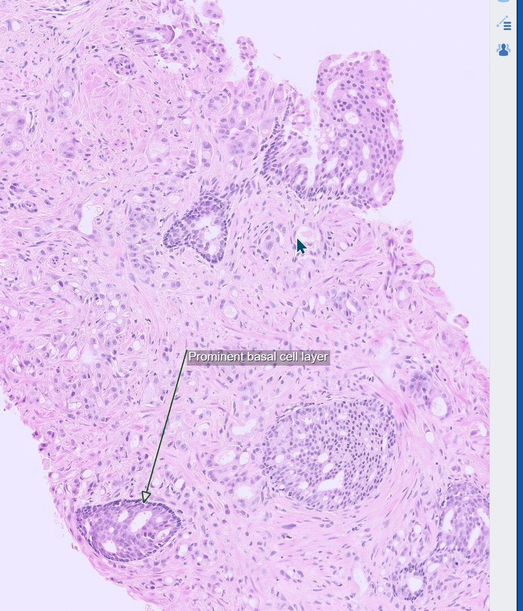 Field of High grade acinar adenocarcinom and foci of intraducal carcinoma. #gupath