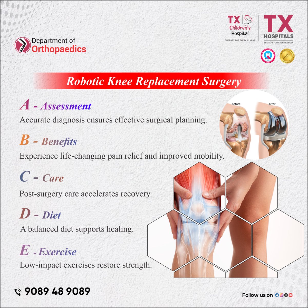 txhospitals's tweet image. 🦵 Robotic Knee Replacement – Pain-Free Mobility! 🤖
✅ Accurate diagnosis &amp;amp; surgical precision
✅ Faster recovery &amp;amp; long-term relief
✅ Diet &amp;amp; exercise support healing
💙 Regain your active lifestyle today!
📞 9089 48 9089 
#RoboticKneeReplacement #JointHealth #TXHospitals