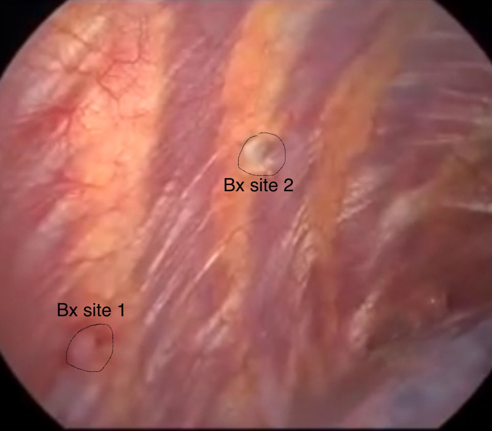 Udit Chaddha (@udit_chaddha) on Twitter photo Humbling curveball
~Biopsy site 1: normal pleura
~Biopsy site 2: HCC
<a href="/AAB_IP/">AABIP</a> <a href="/wabipconnect/">WABIP</a> <a href="/UKPleura/">UK Pleural Society</a> <a href="/YCGaryLee/">Y C Gary Lee</a> Humbling curveball
~Biopsy site 1: normal pleura
~Biopsy site 2: HCC
<a href="/AAB_IP/">AABIP</a> <a href="/wabipconnect/">WABIP</a> <a href="/UKPleura/">UK Pleural Society</a> <a href="/YCGaryLee/">Y C Gary Lee</a>