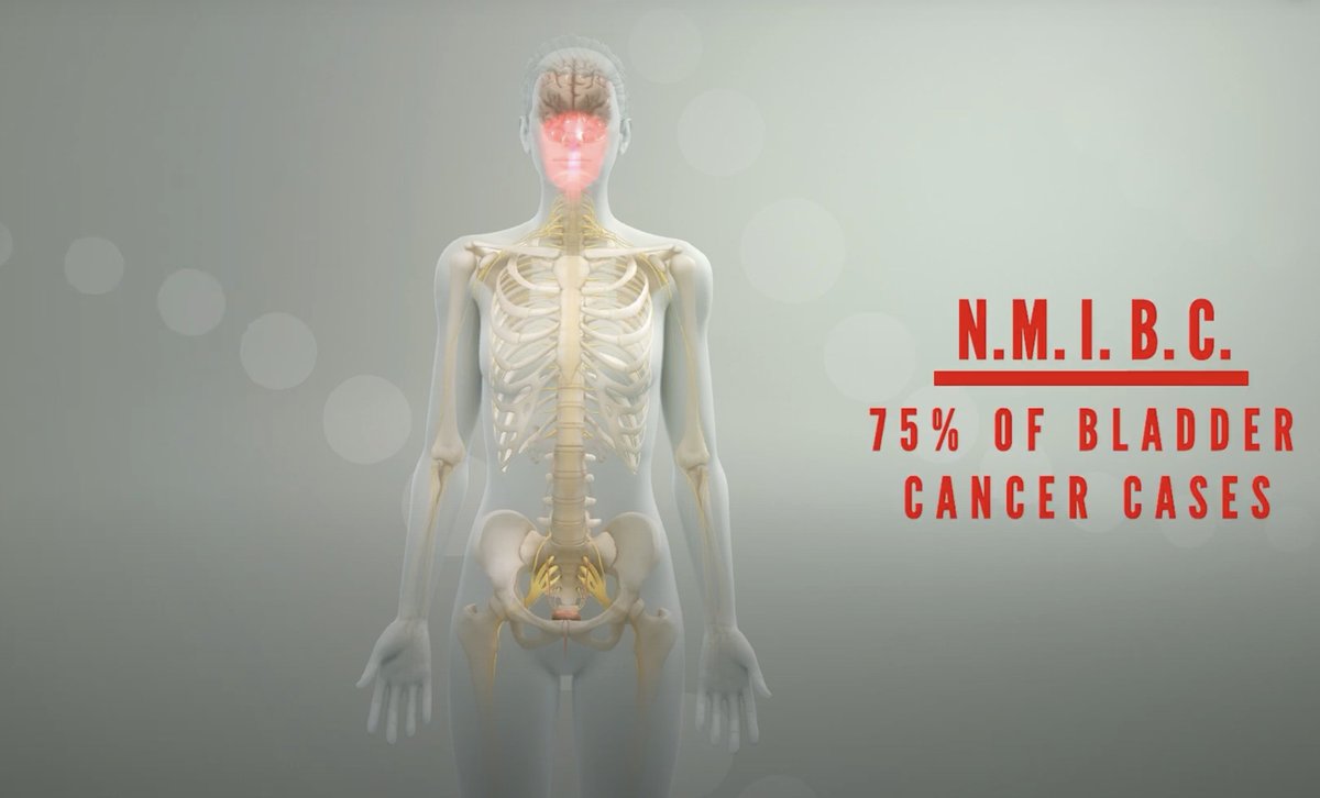 UC San Diego Health Moores Cancer Center (@ucsdcancer) on Twitter photo Doctors at <a href="/UCSanDiego/">UC San Diego</a> are among the first in the U.S. to offer an <a href="/US_FDA/">U.S. FDA</a> approved gene therapy that may help #bladdercancer patients avoid removal surgery. 💡
MCC's <a href="/AmirSalmasi/">Amir Salmasi</a> is leading this discovery and shares its promising potential: bit.ly/3CHLedB. Doctors at <a href="/UCSanDiego/">UC San Diego</a> are among the first in the U.S. to offer an <a href="/US_FDA/">U.S. FDA</a> approved gene therapy that may help #bladdercancer patients avoid removal surgery. 💡
MCC's <a href="/AmirSalmasi/">Amir Salmasi</a> is leading this discovery and shares its promising potential: bit.ly/3CHLedB.