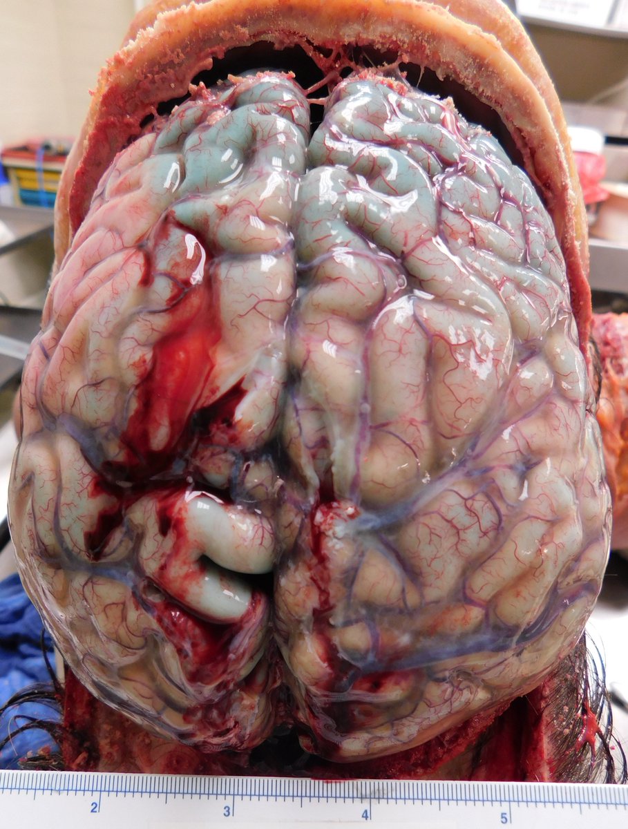 leon_metlay's tweet photo. A colleague's old case. Adult with hx of drug use, acute stroke, progressive multiorgan failure. Pictures of heart, brain, kidney. What's the lesion? Bonus question- what's the color? https://t.co/aIJZNDOFst